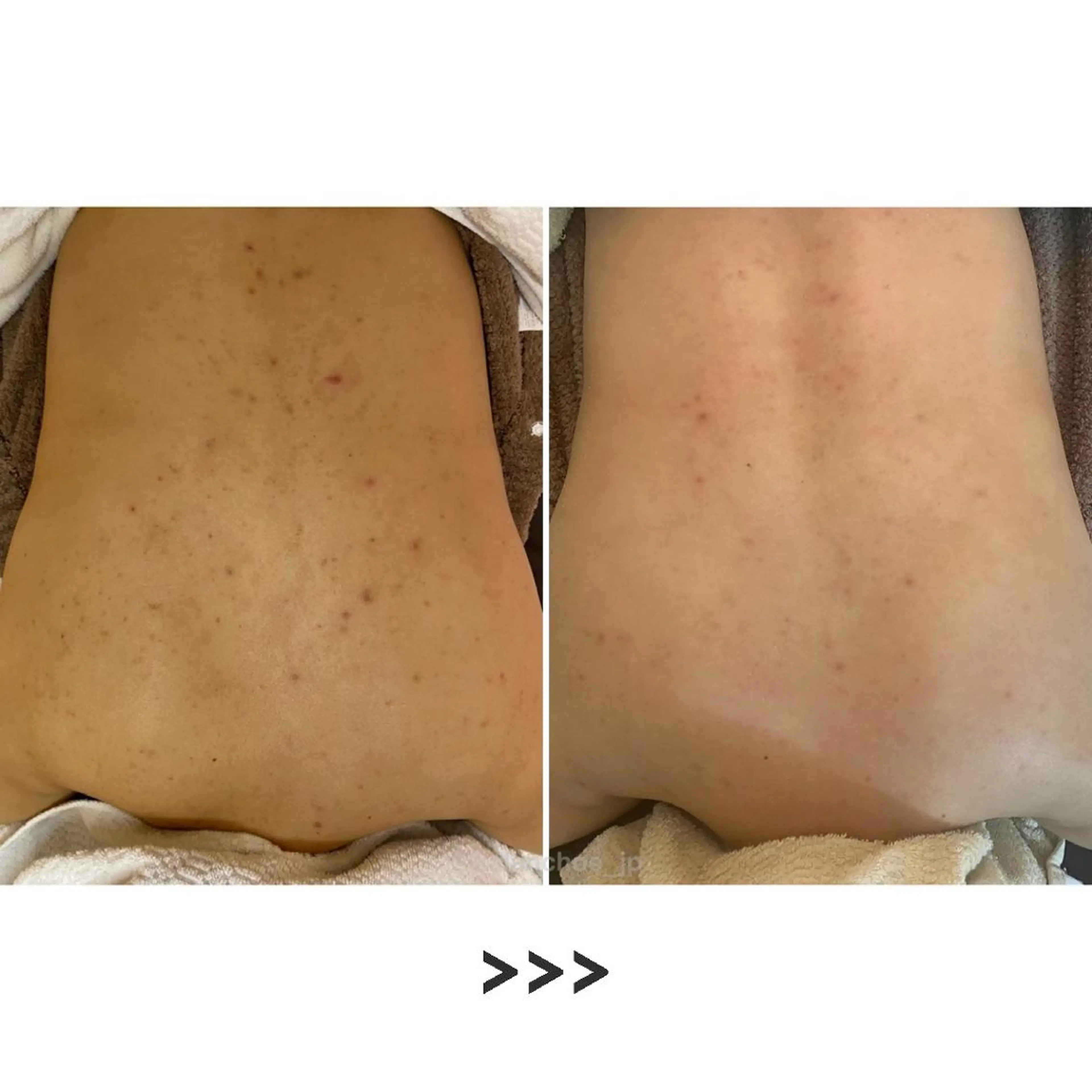 エステ リラク 肌質改善 KALANCHOEのエステ・リラクイメージ