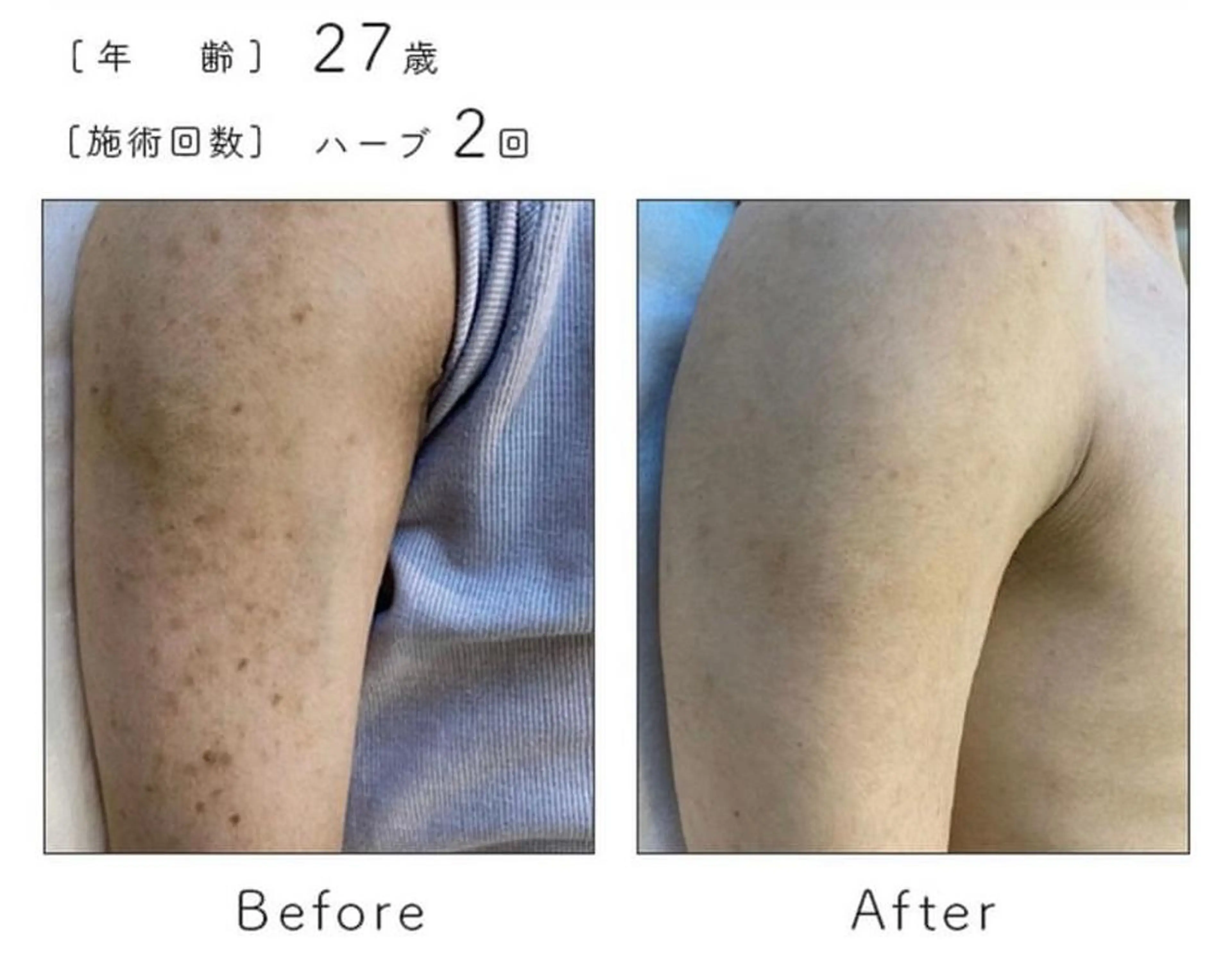 【二の腕ニキビ・毛孔性苔癬】ハーブピーリングの写真