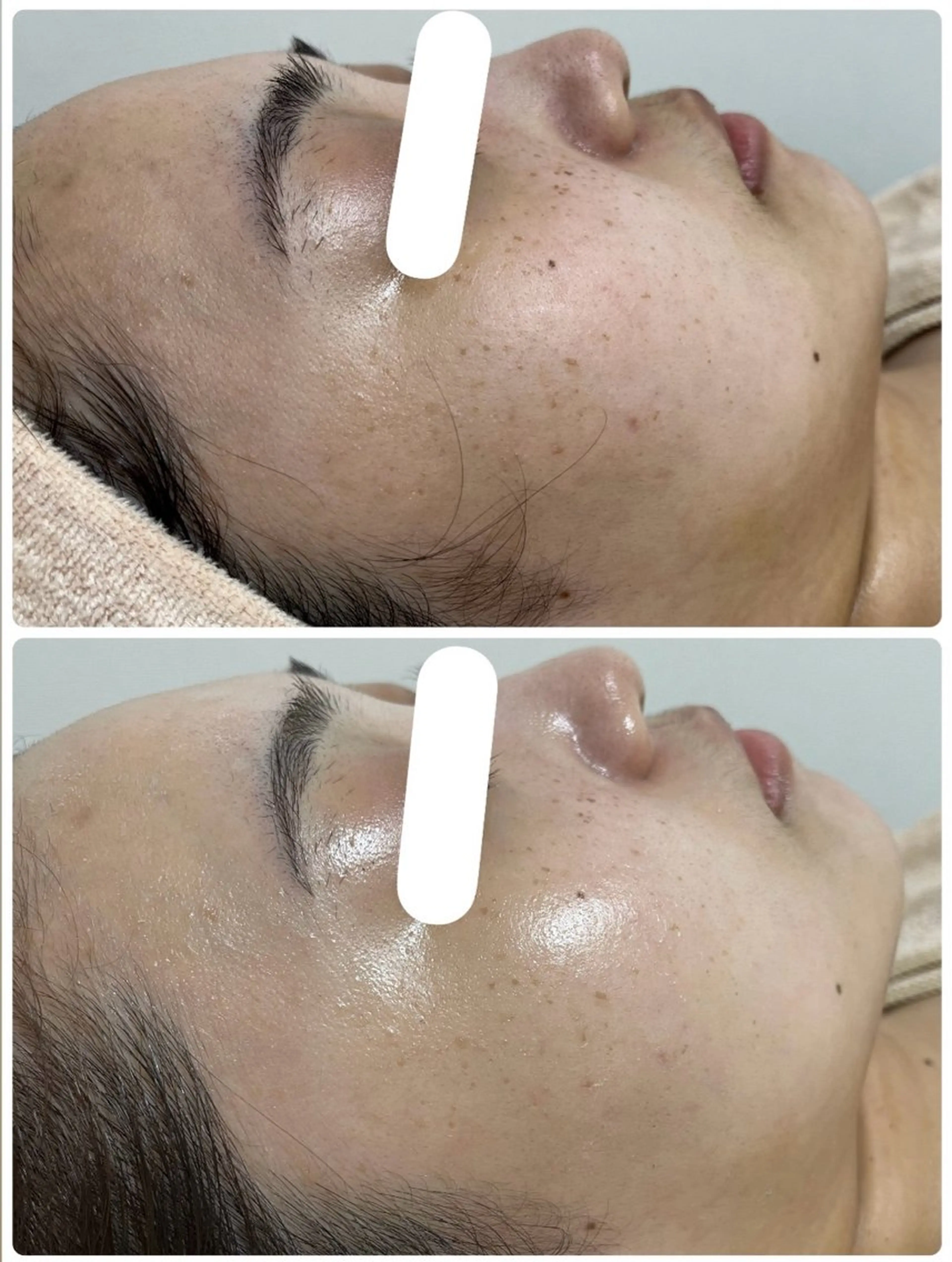 ニキビ／毛穴ケア ハーブピーリングのエステ・リラクイメージ