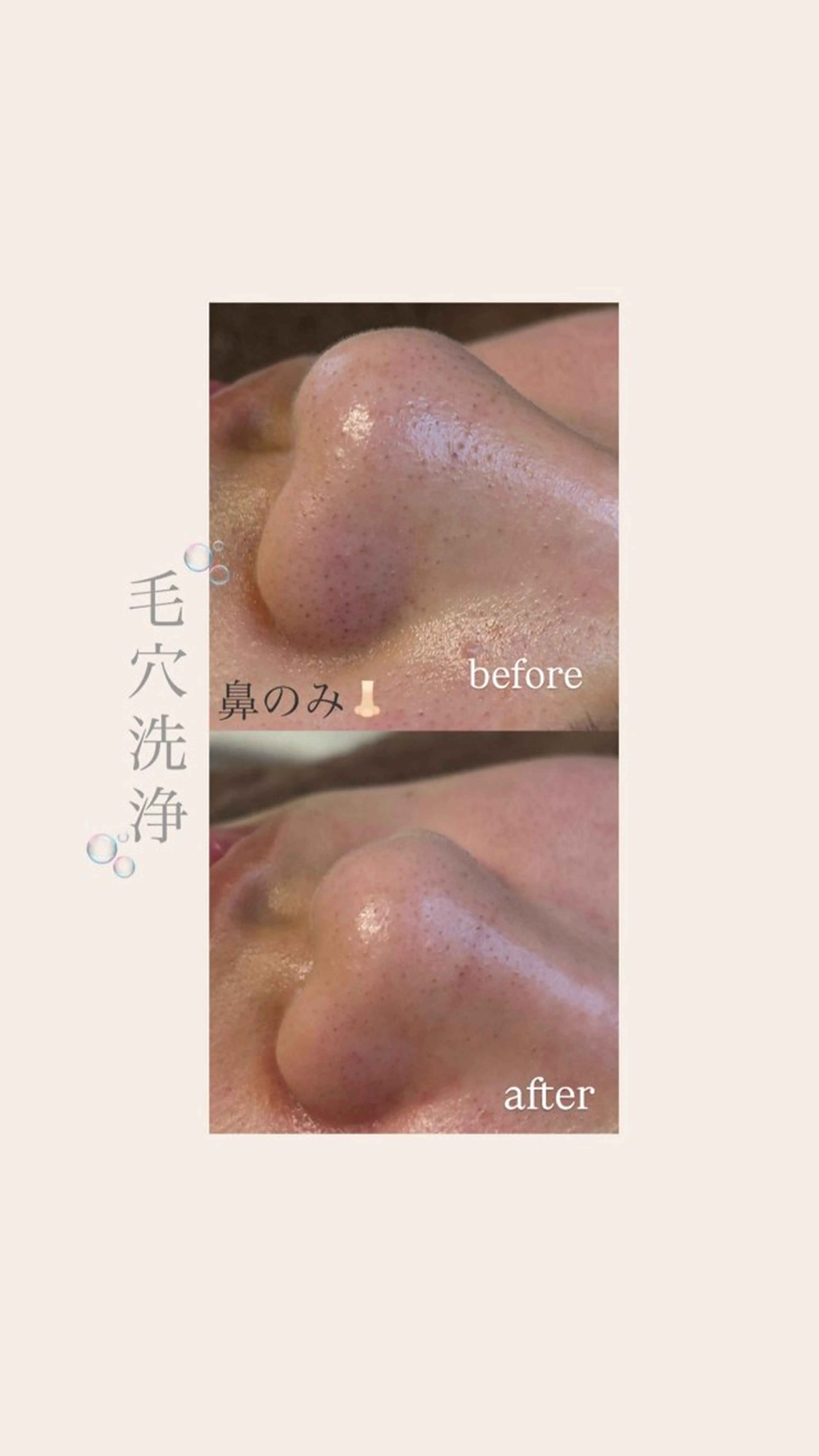 【🍓いちご鼻や角栓撃退👃🏻】鼻のみ毛穴洗浄ハイドラフェイシャル🫧の写真