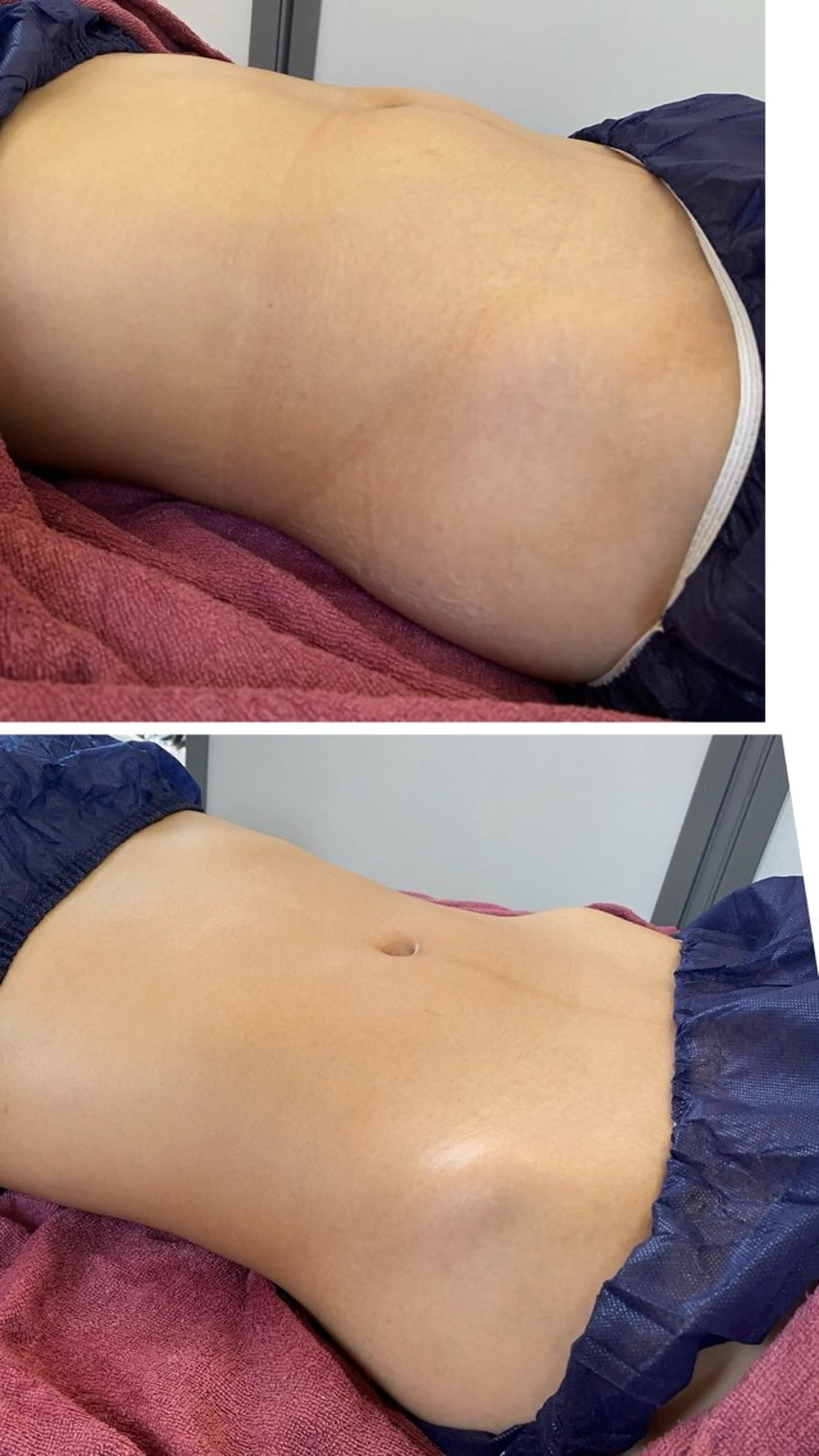 お腹くびれコース❣️痩身(ラジオ波×吸引引き上げ×LED)✨の写真