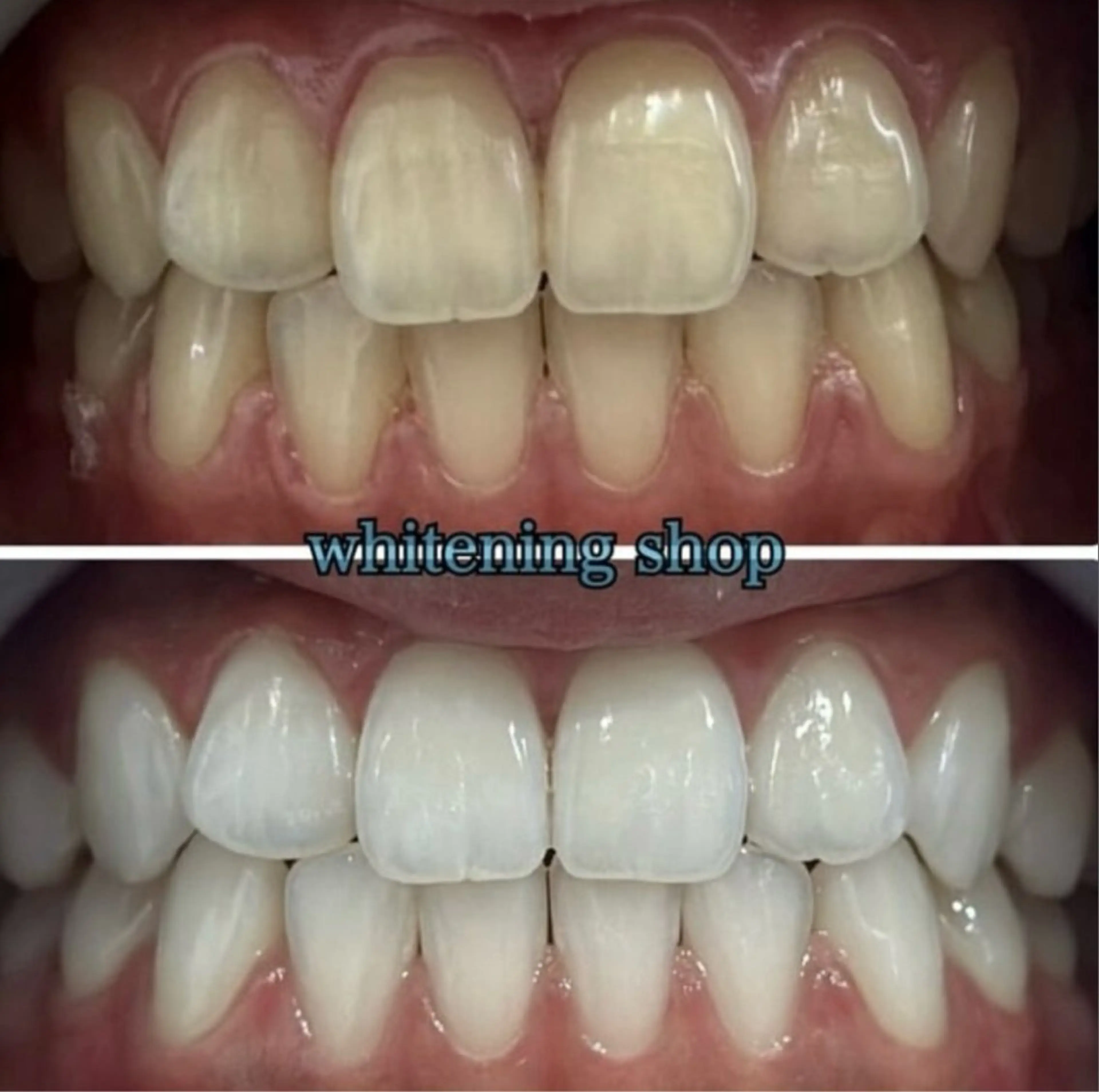 【浦和で人気のホワイトニング】【リーズナブル×圧倒的効果】 ¥8,800→¥3,980🦷💎✨️の写真