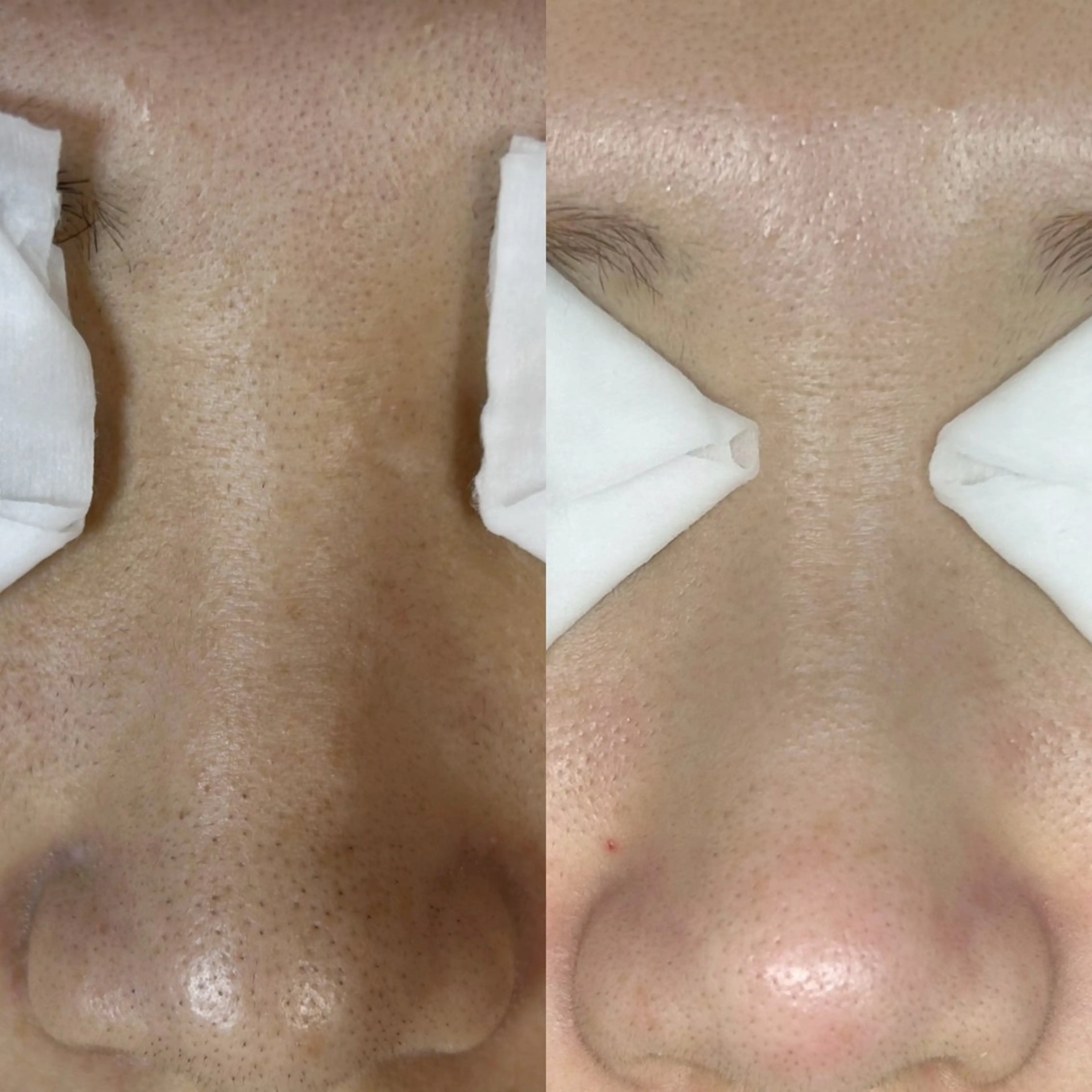 毛穴詰まりたるみくすみ解消80分コースの写真