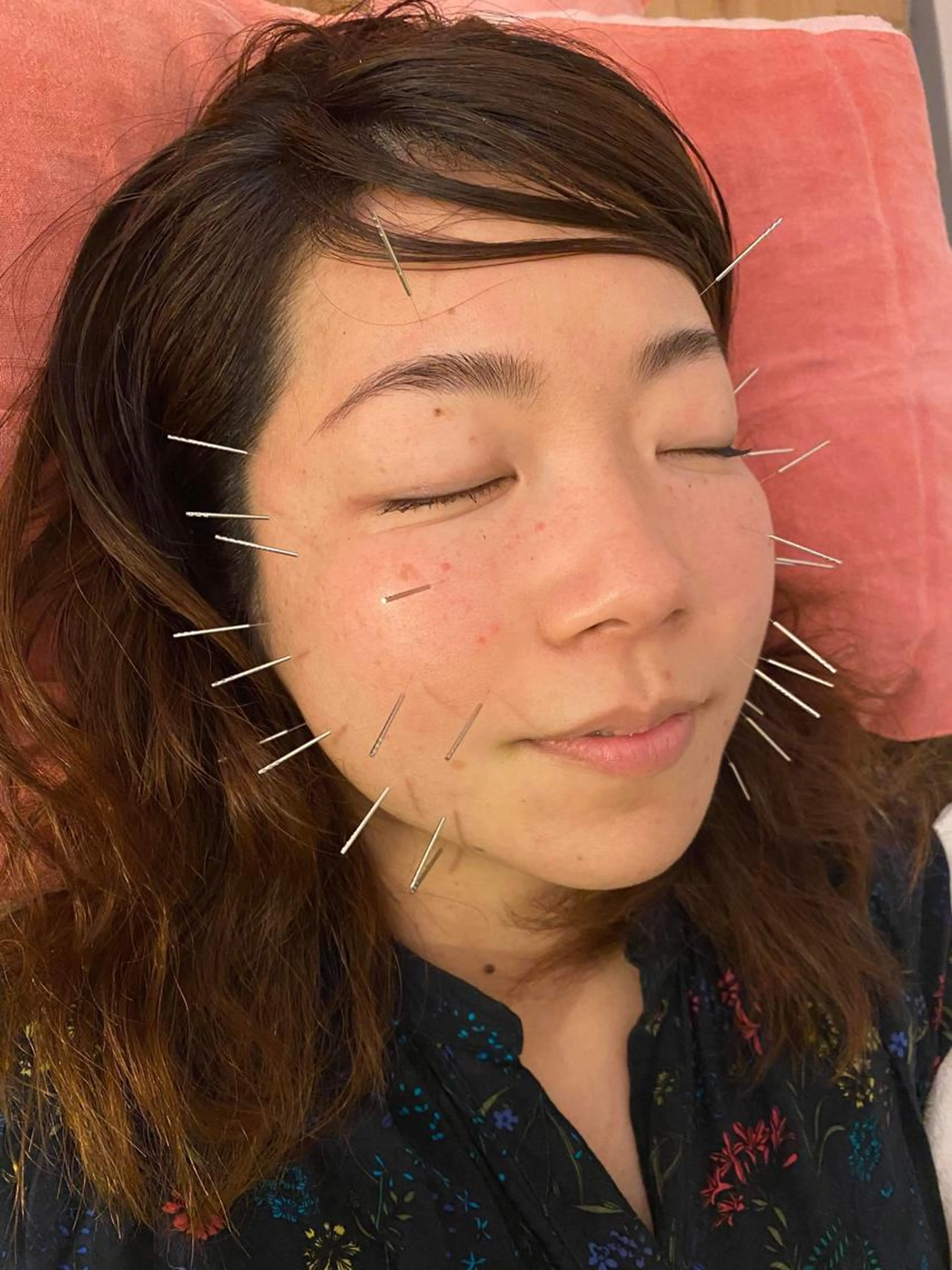 やさしい美容鍼＋全身調整（90分）― リラックスしながら整えるケアコース ―の写真