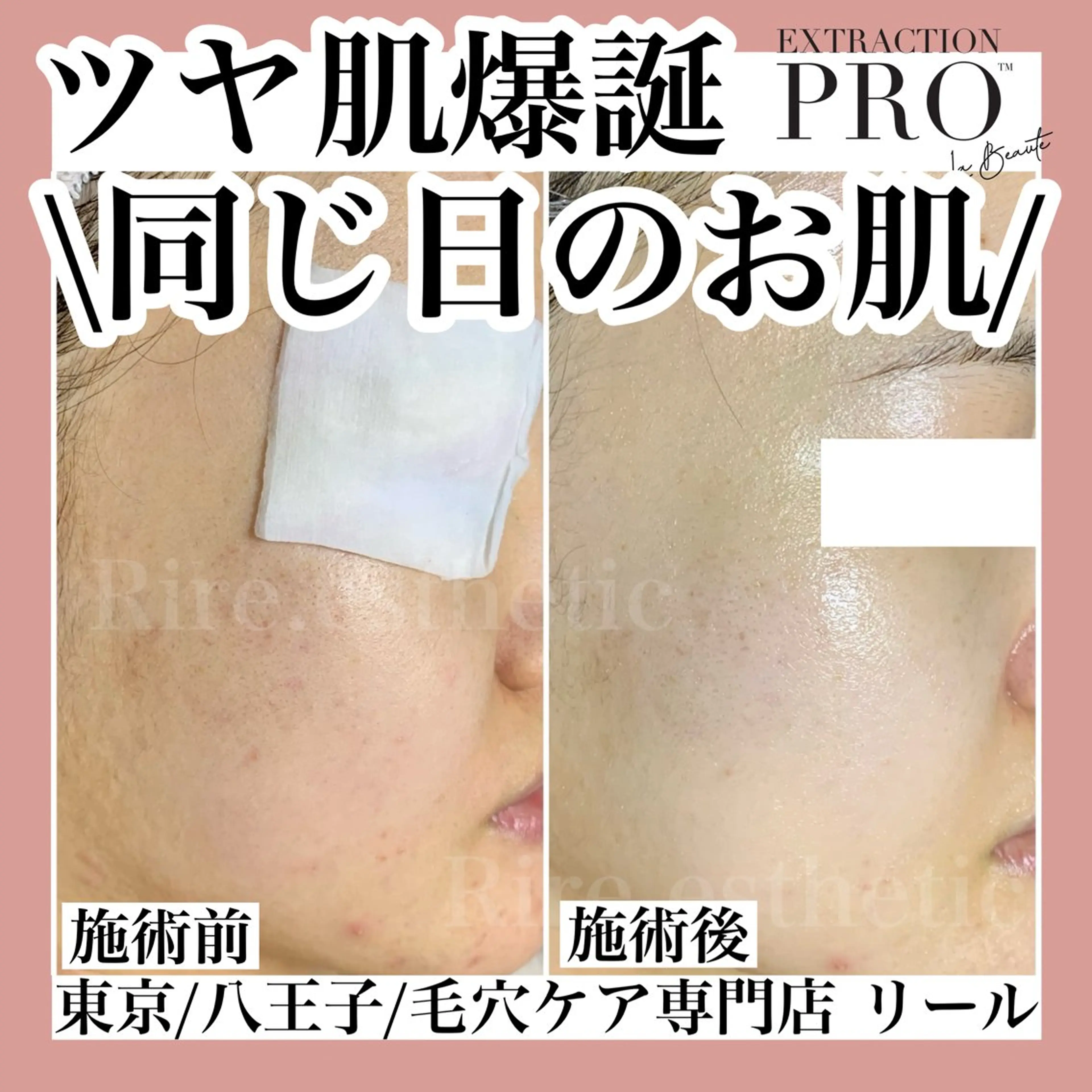 毛穴特化エステ -リールのエステ・リラクイメージ