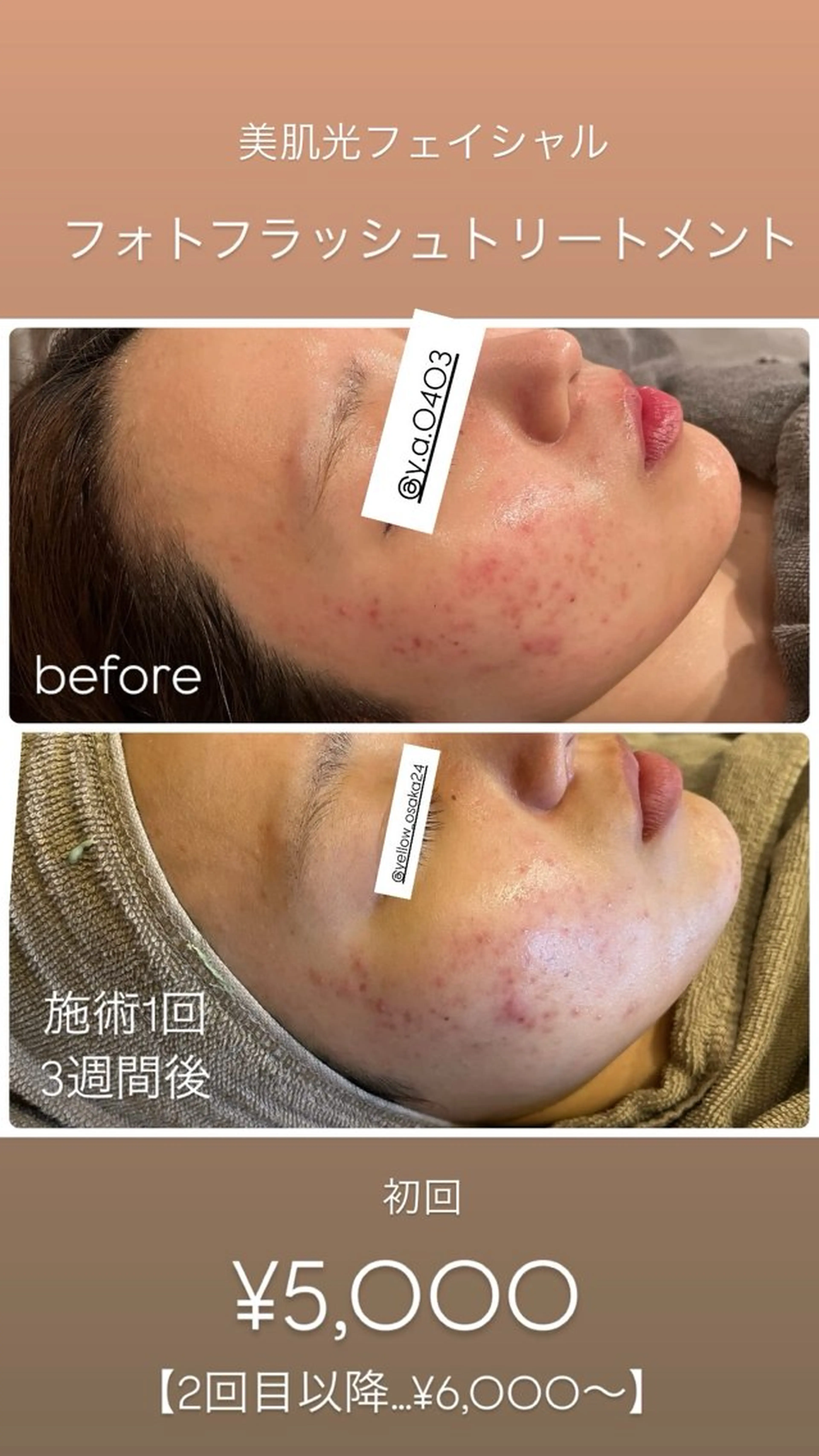 脱毛 yellow💛【 脱毛&フェイシャル】のエステ・リラクイメージ