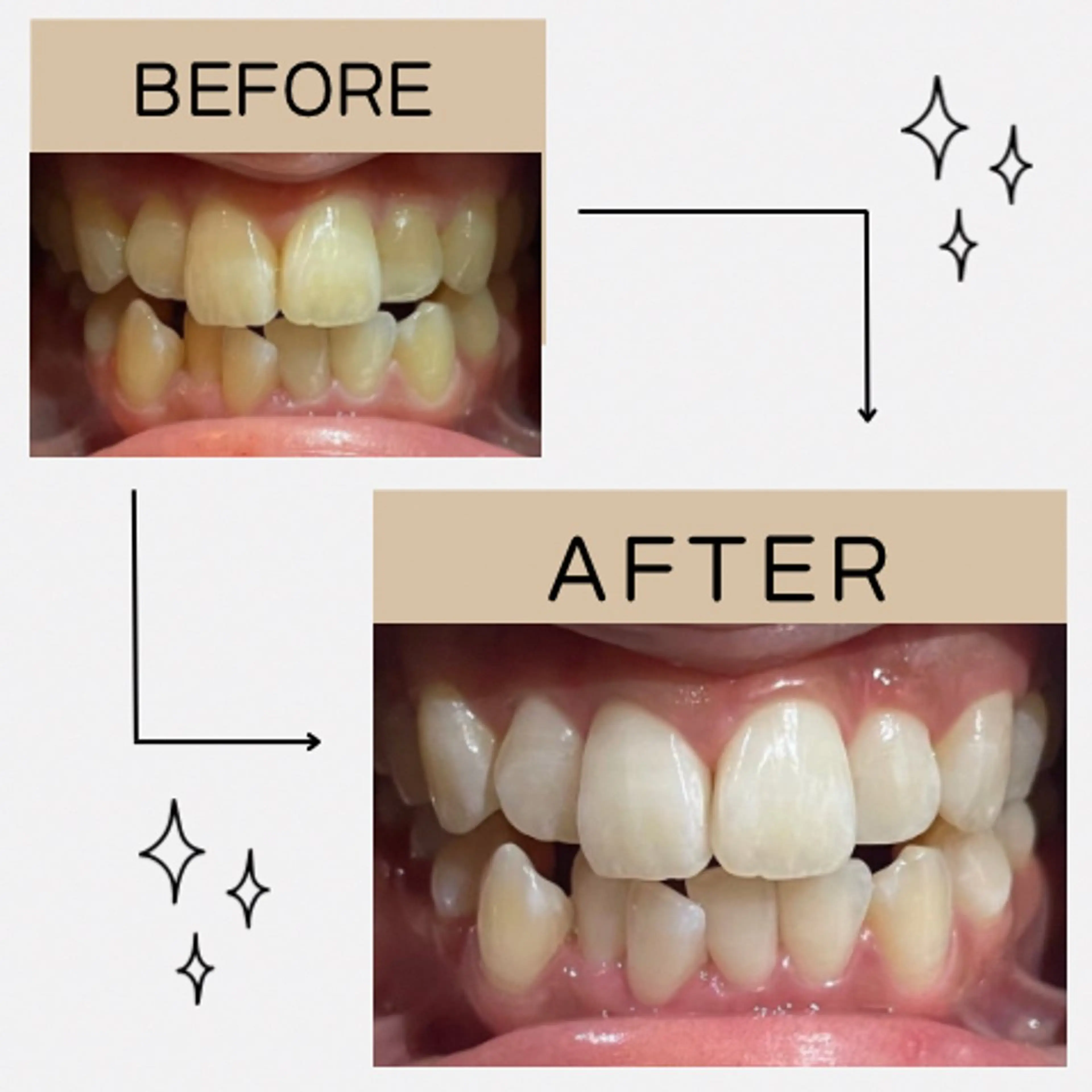 その他 サクッとホワイト都立大学店所属・セルフホワイトニング 都立大学🦷✴︎のその他イメージ