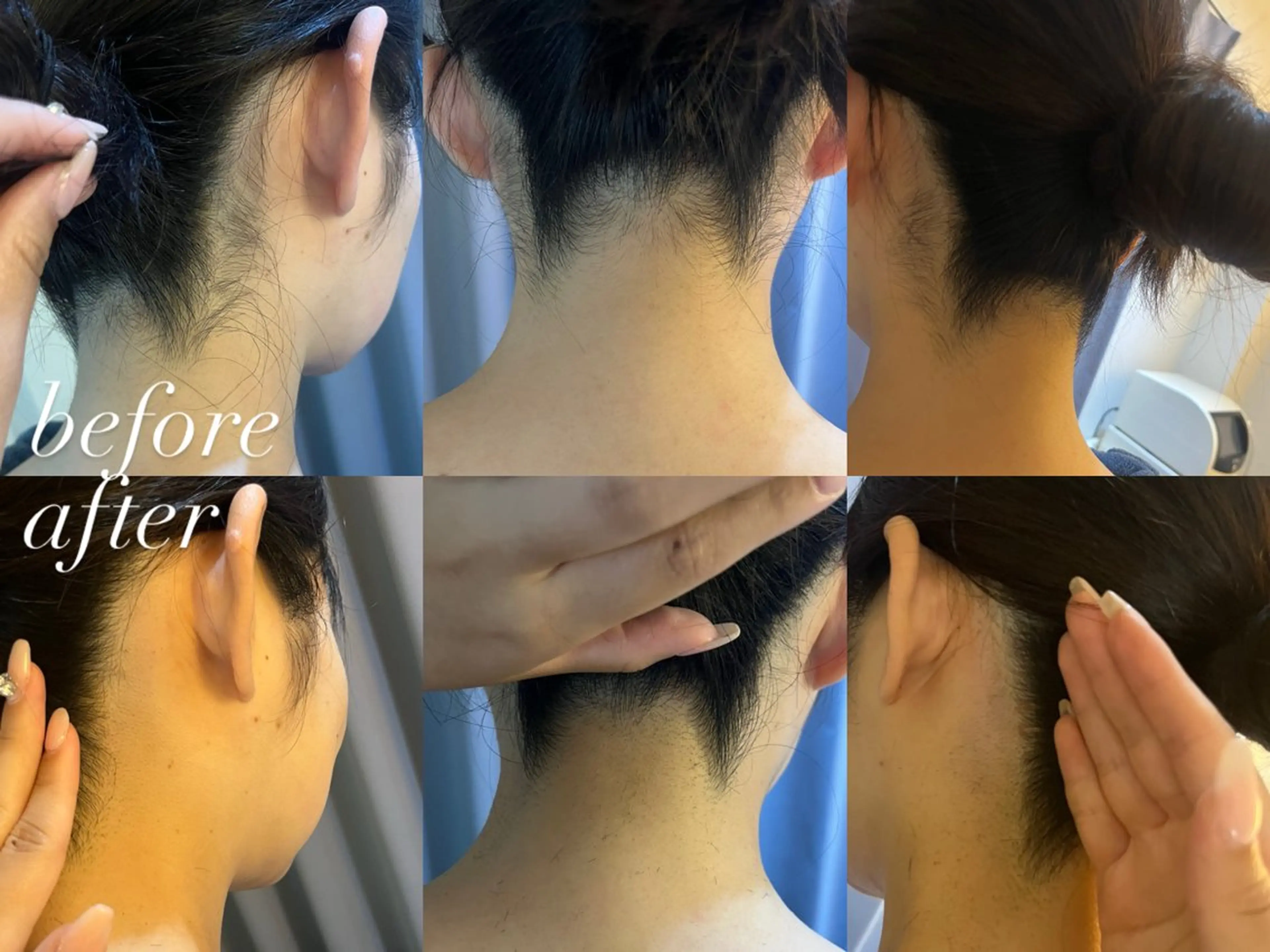 脱毛 うなじ脱毛/美肌脱毛 LABELのエステ・リラクイメージ