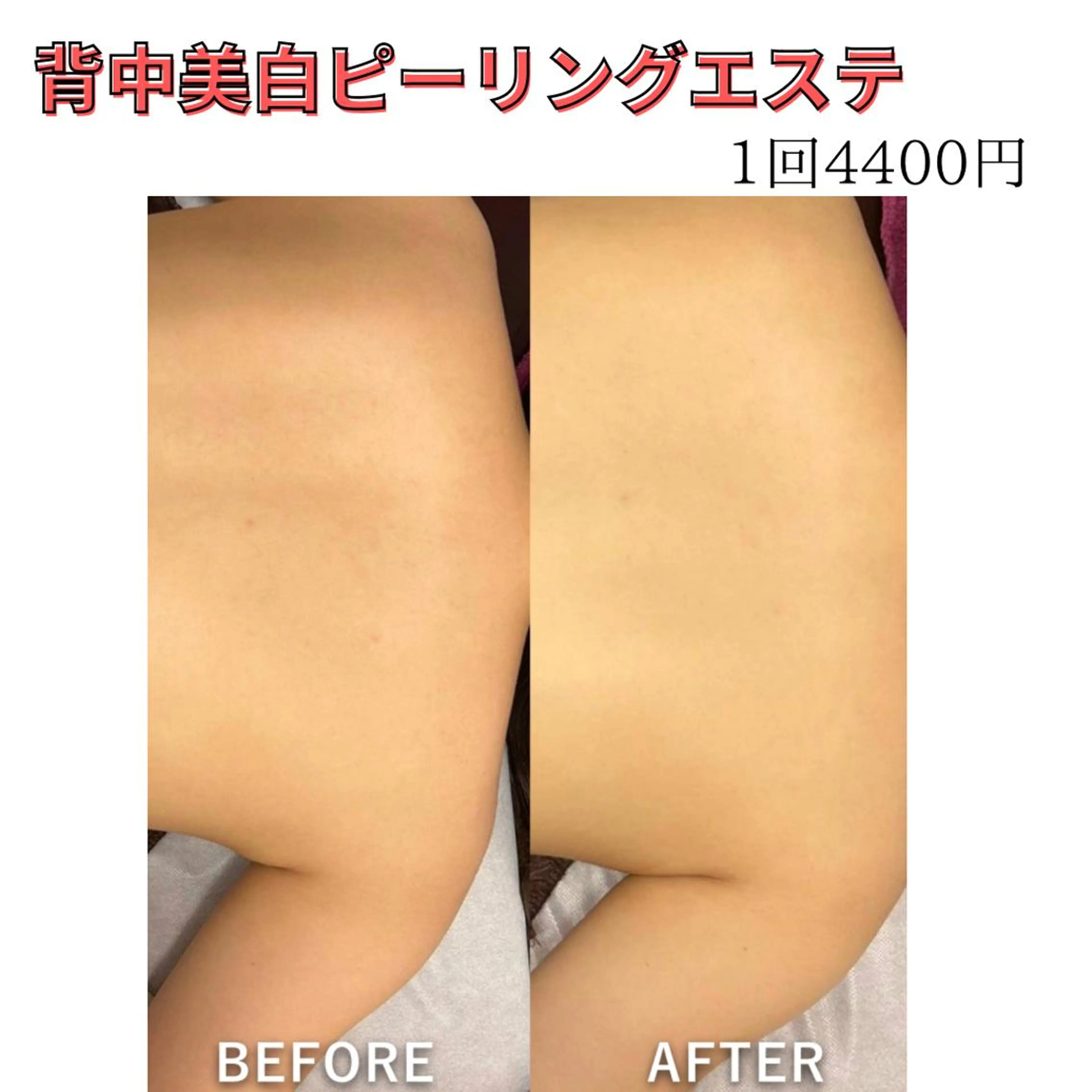 【ボディエステ人気No.2】背中ピーリング美白ケア💎新規様の写真