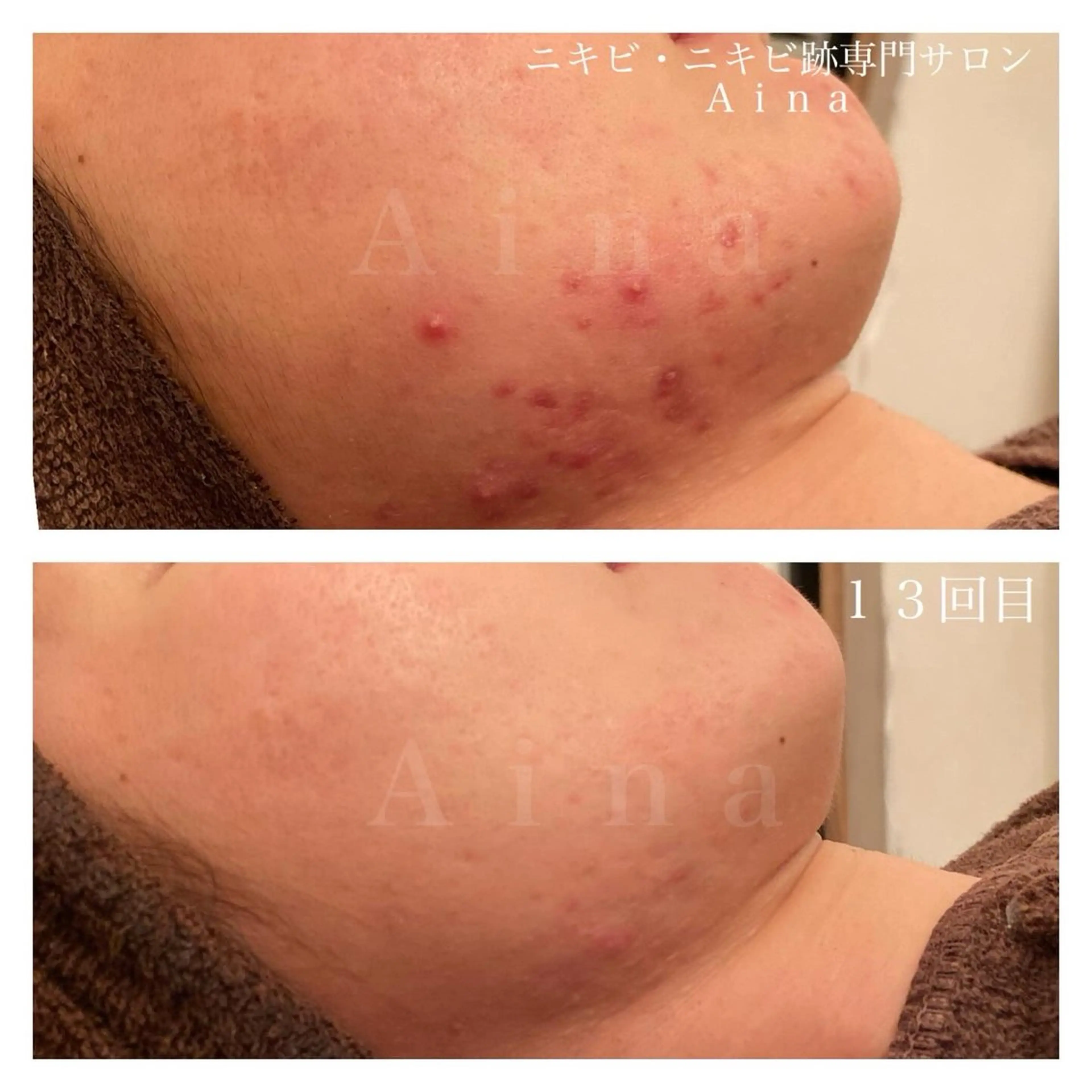 エステ リラク ニキビ跡専門サロン Ａｉｎａのエステ・リラクイメージ