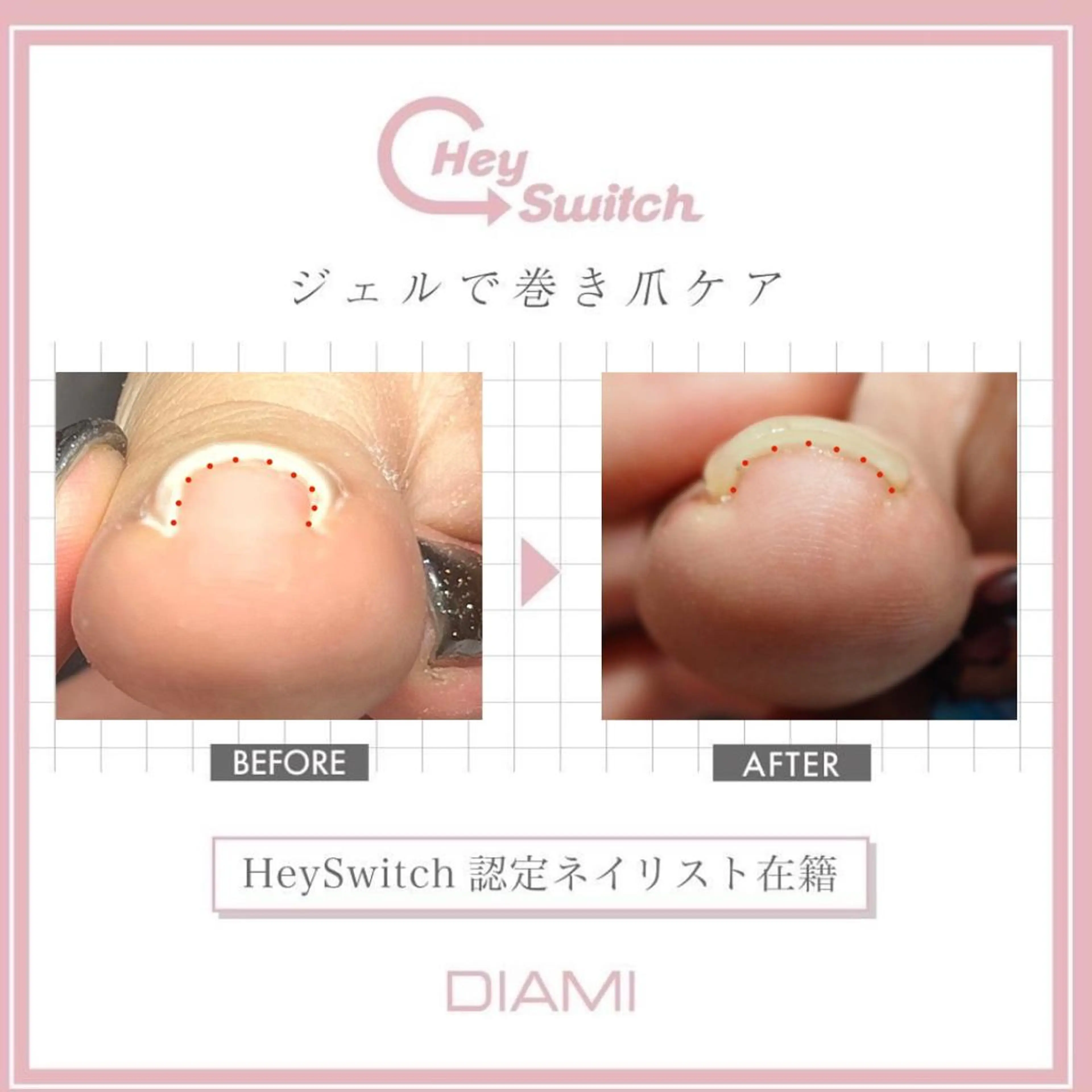 【特殊ジェルで行う巻き爪ケア】2回目まで両親指半額の¥5500!(最低でも4回の施術がおすすめです)の写真