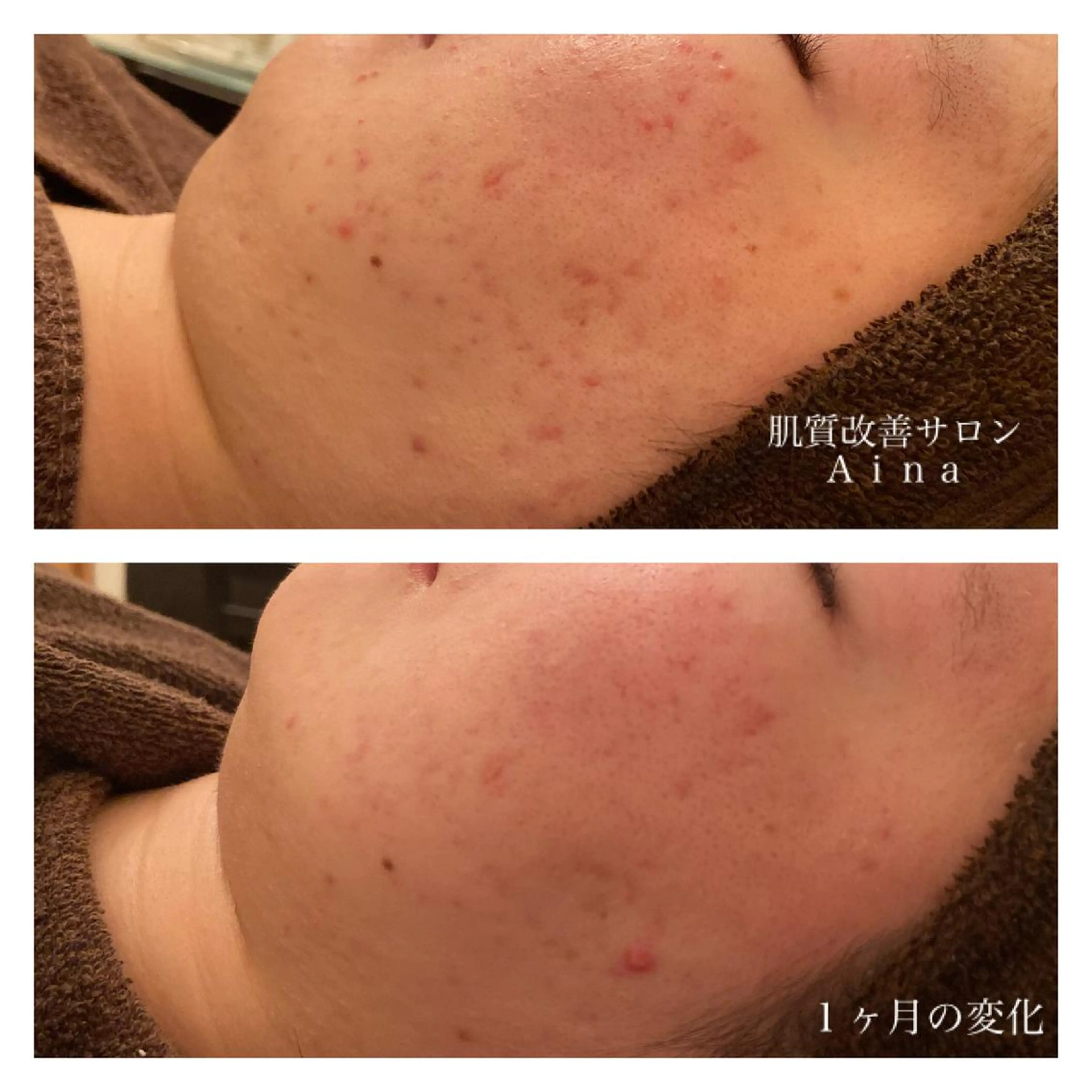 ミディアム カラー パーマ ヘアアレンジ メンズ キッズ ネイル マツエク・マツパ エステ リラク ニキビ跡専門サロン Ainaのエステ・リラクイメージ