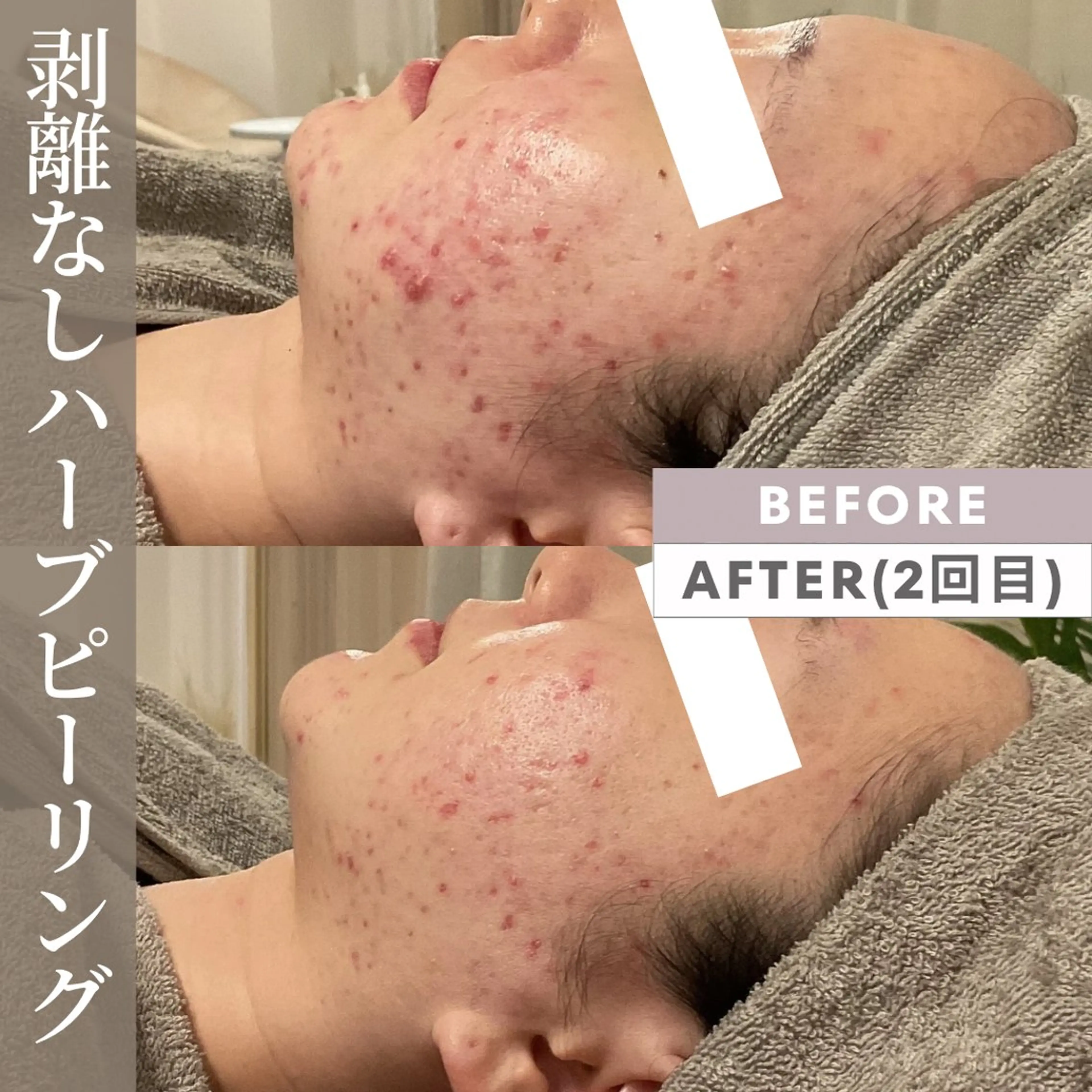 エステ 美肌サロン💎ハーブ ピーリング🌿ルプレのエステ・リラクイメージ