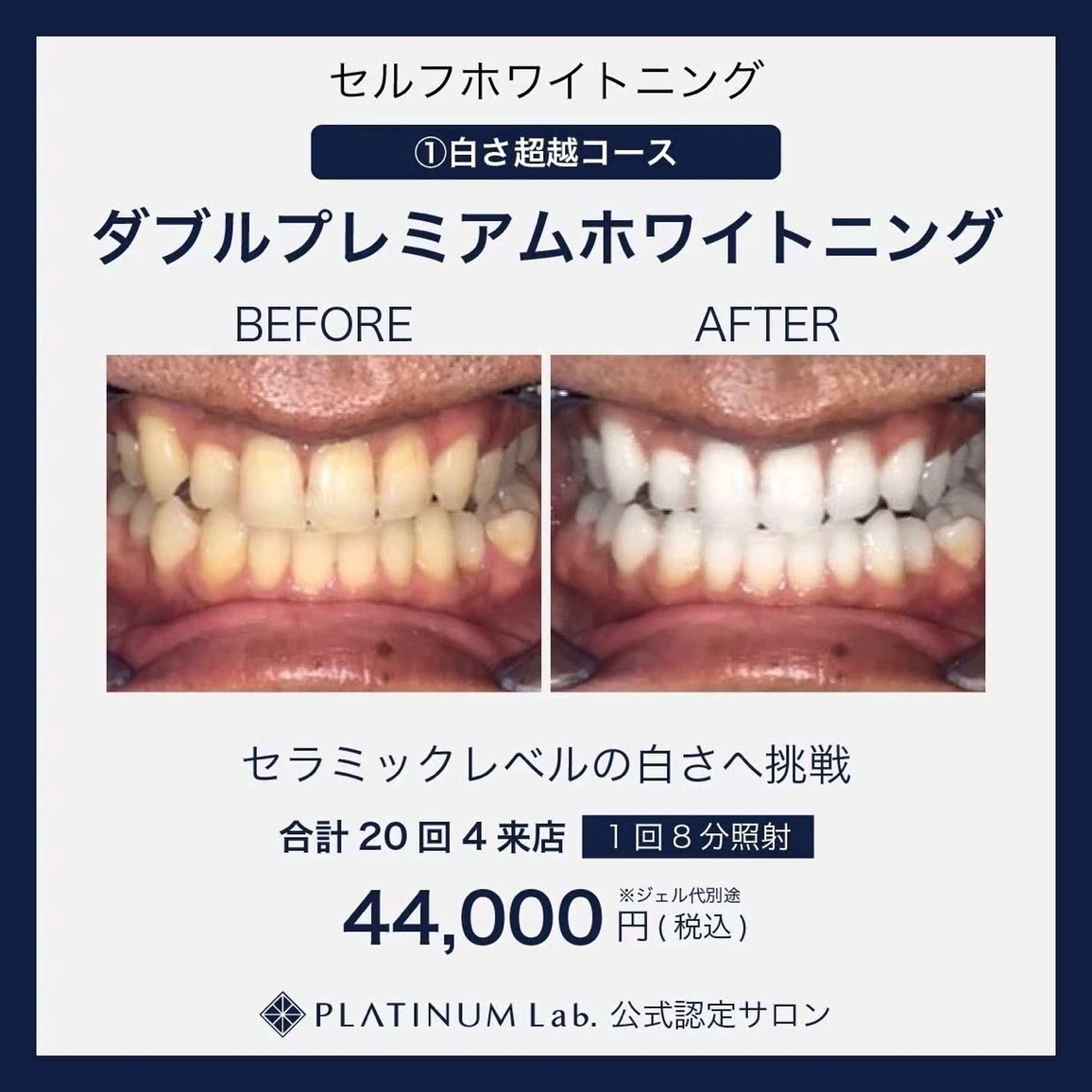 【新規様限定】プレミアムセルフホワイトニング40分×4来店　合計160分🦷✨の写真