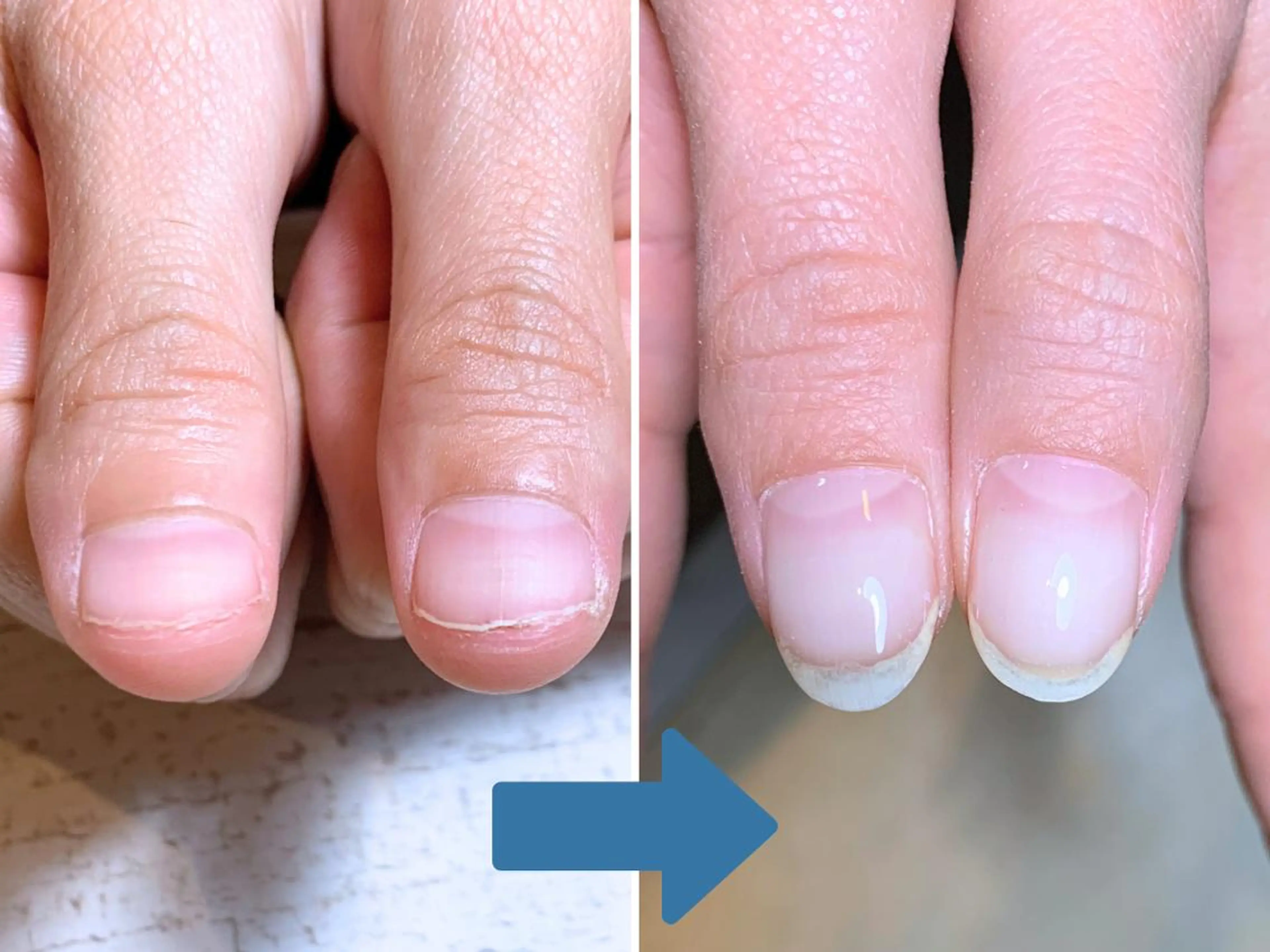 ネイル 深爪矯正・自爪育成 ネイルサロンアモまいのネイルデザイン