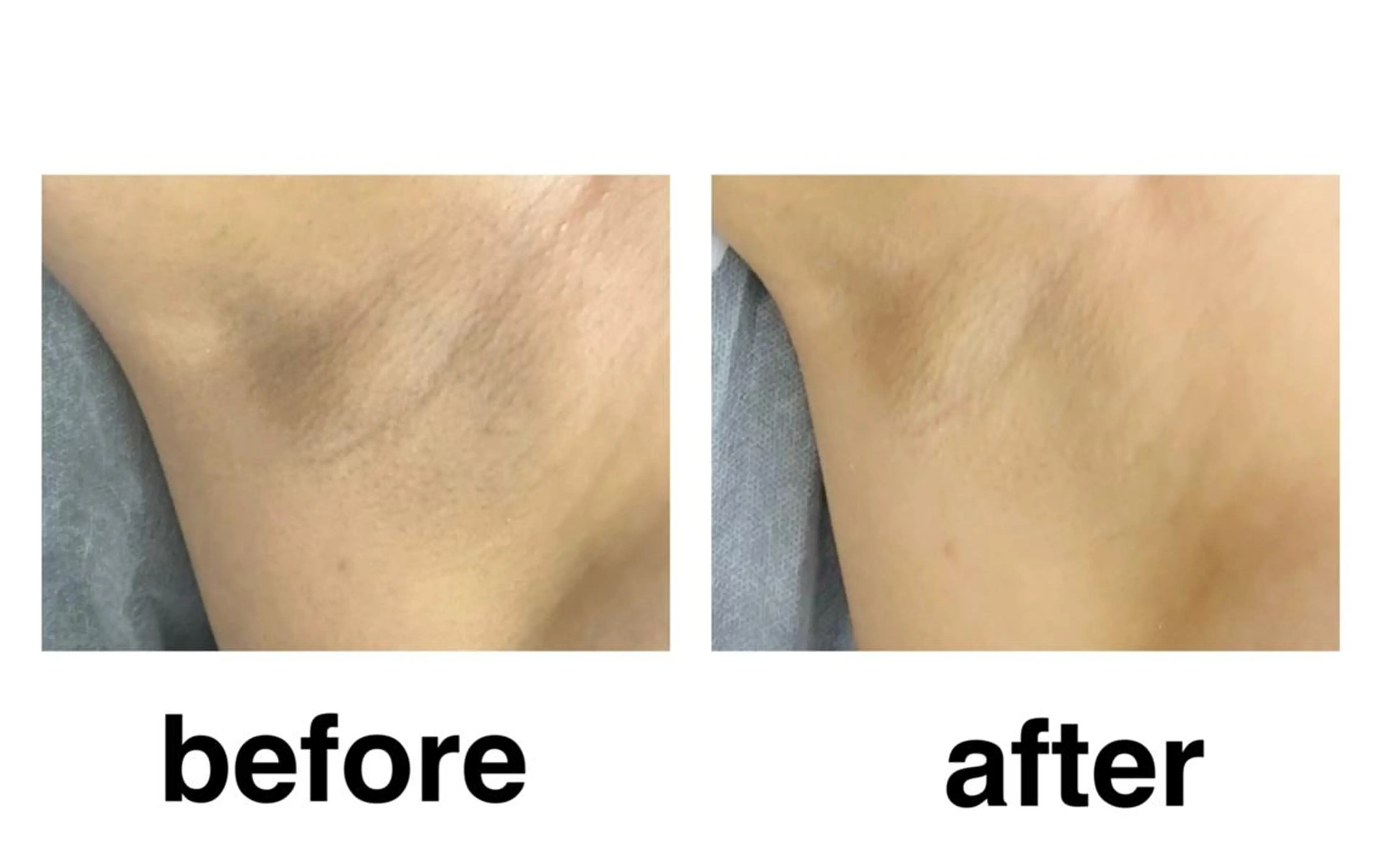 カサカサ肌に◎剥離なしハーブピーリング🌿【脇or肘or膝or手の甲orかかと】国産🌿くすみに◎ブライダルにも✨の写真