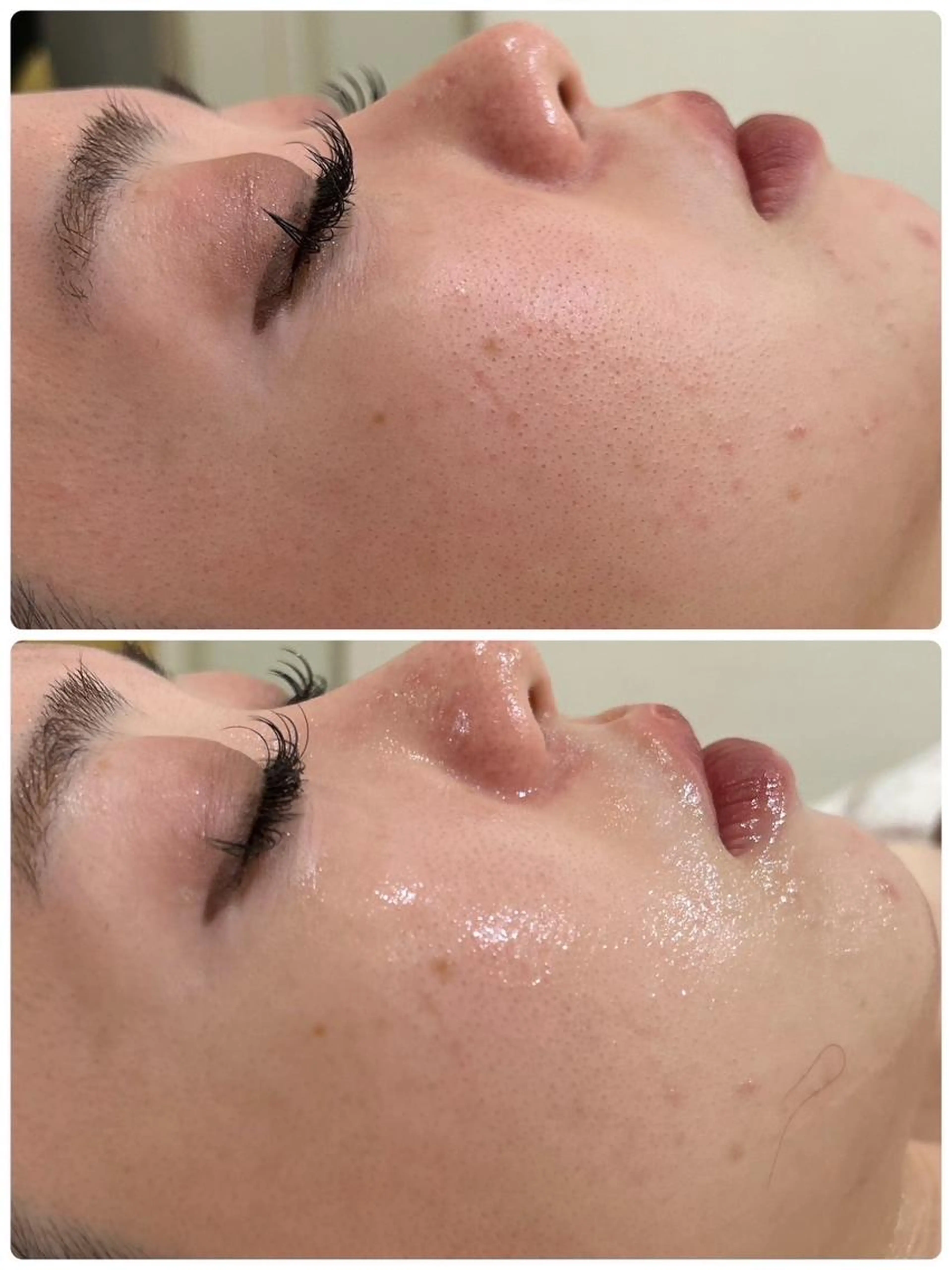 【フォト×脱毛】最新プラズマ照射でお肌の根本改善！お顔の毛にもアプローチ！長年のお悩みでも解決💗の写真