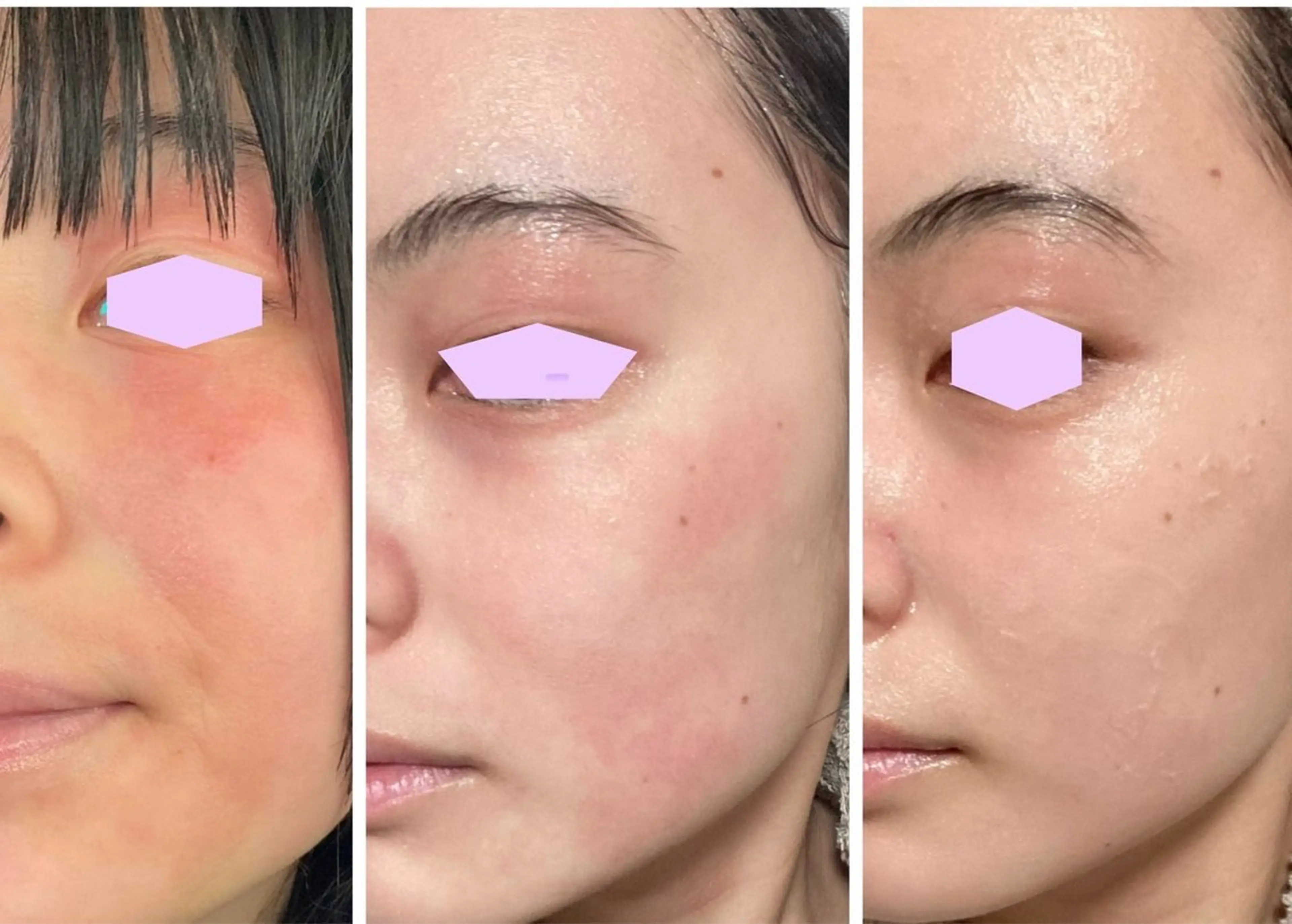 ★花粉症皮膚炎や日焼けの炎症肌、湿疹、赤ら顔、ハリの低下によるしわ、レストセル60分の写真