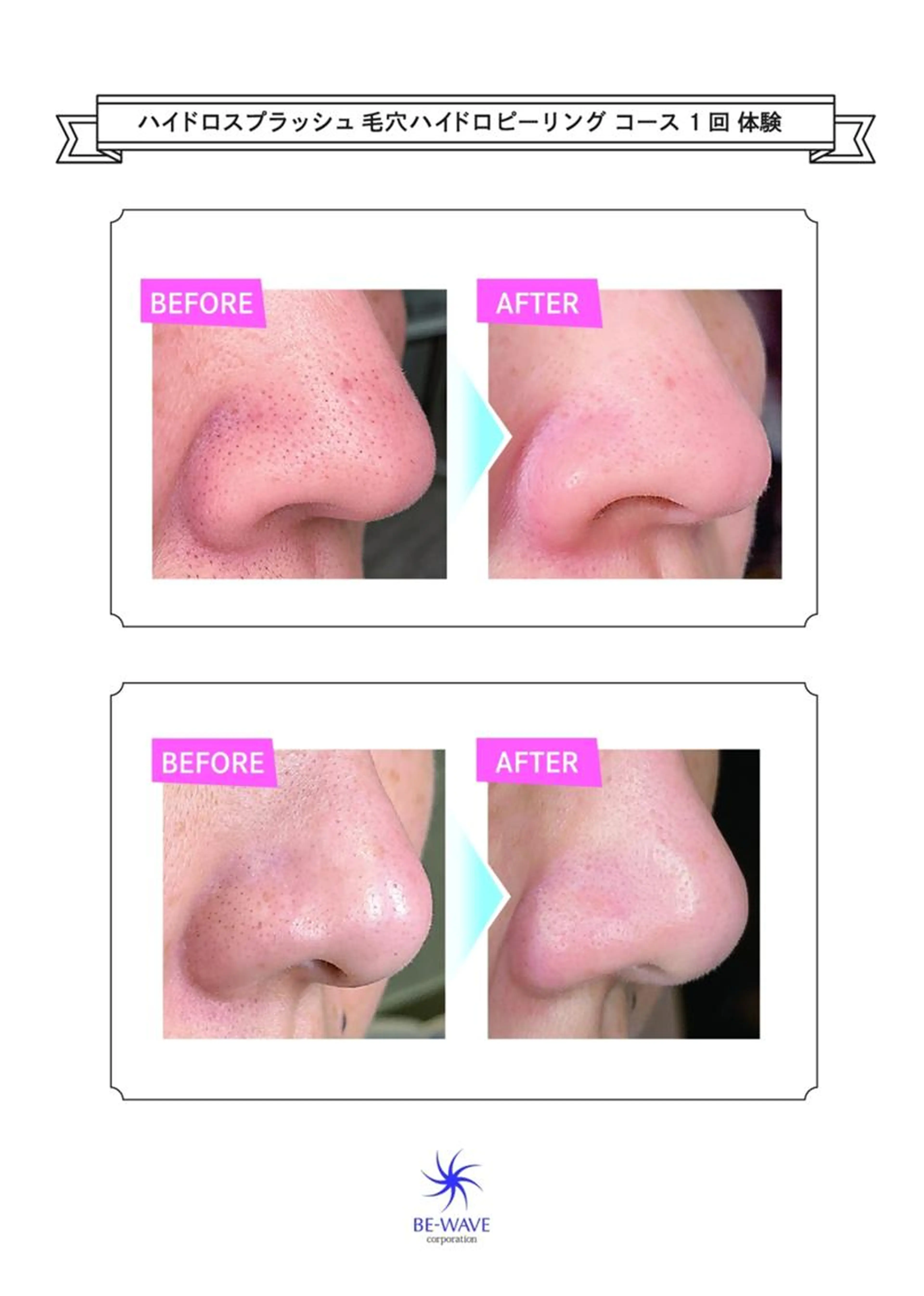 ハイドロピーリング毛穴洗浄(パック&デコルテつき)60分 県内在住の方限定価格★の写真