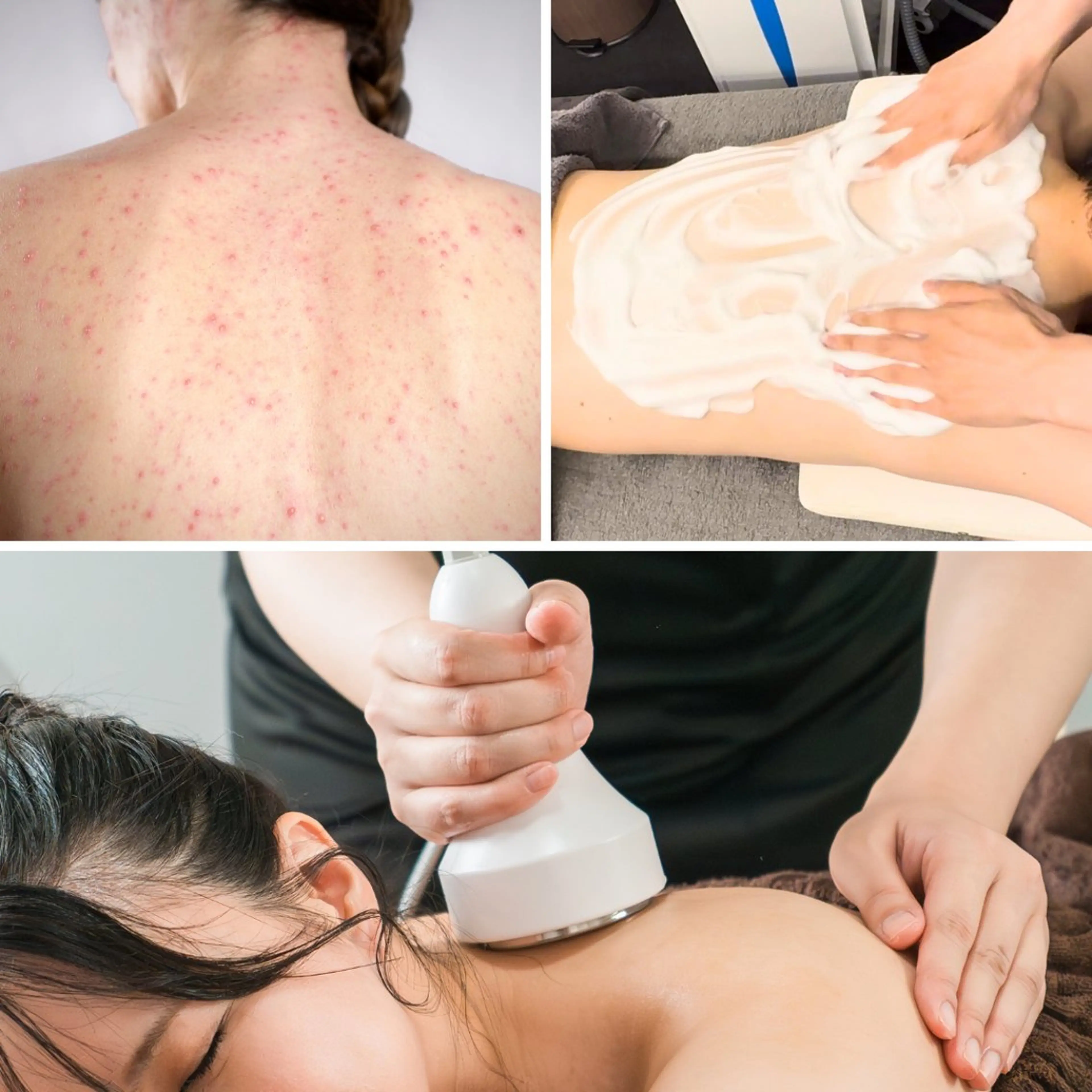 背中の肌トラブルを整える集中ケアセット ✨男女どなたでも◎の写真