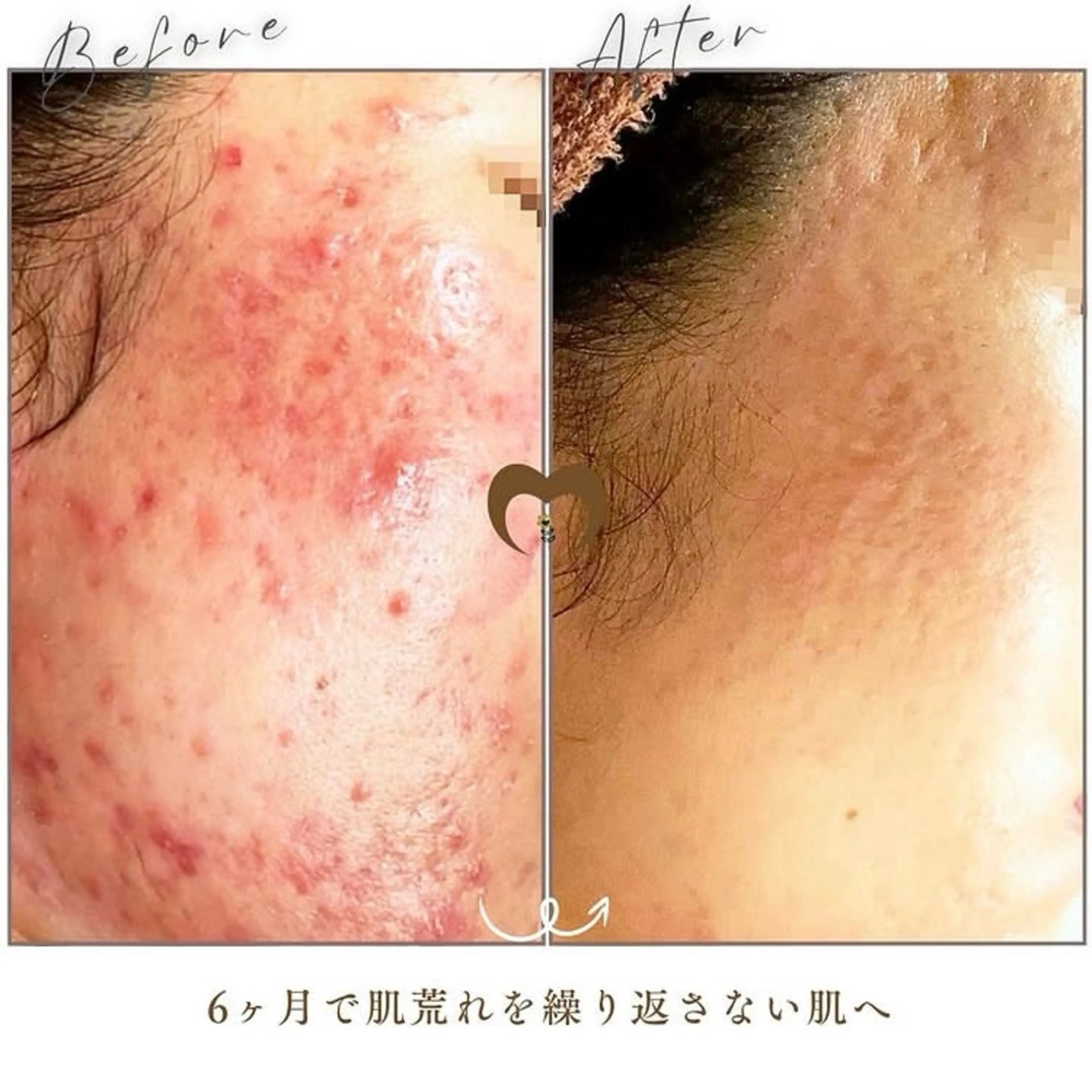 繰り返すニキビ・毛穴 ✨つくば肌質改善専門のエステ・リラクイメージ