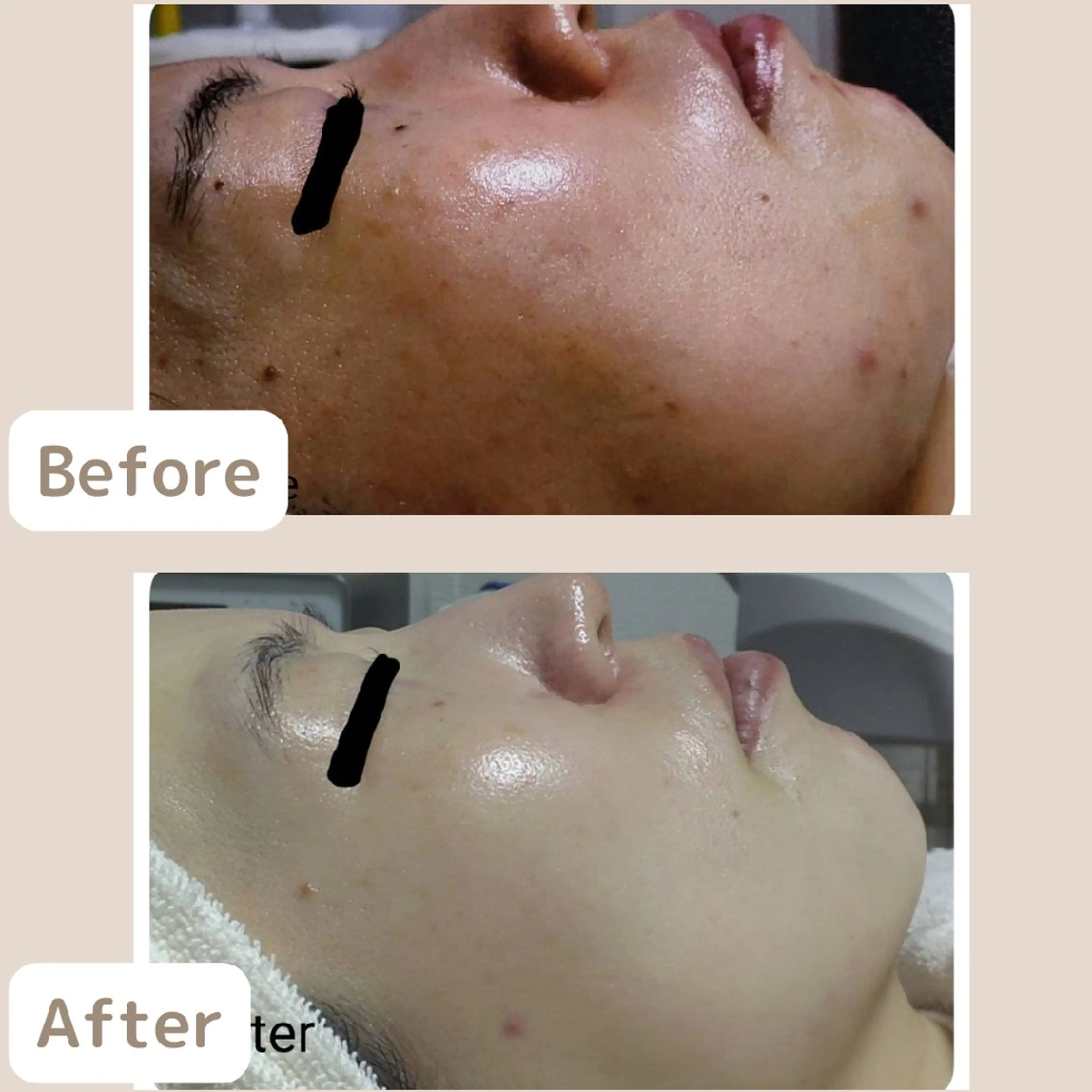 人気NO.1✨《繰り返すニキビにお悩みの方》社会人🈹本気のニキビケア2回体験　[大阪城北詰/京橋駅]の写真