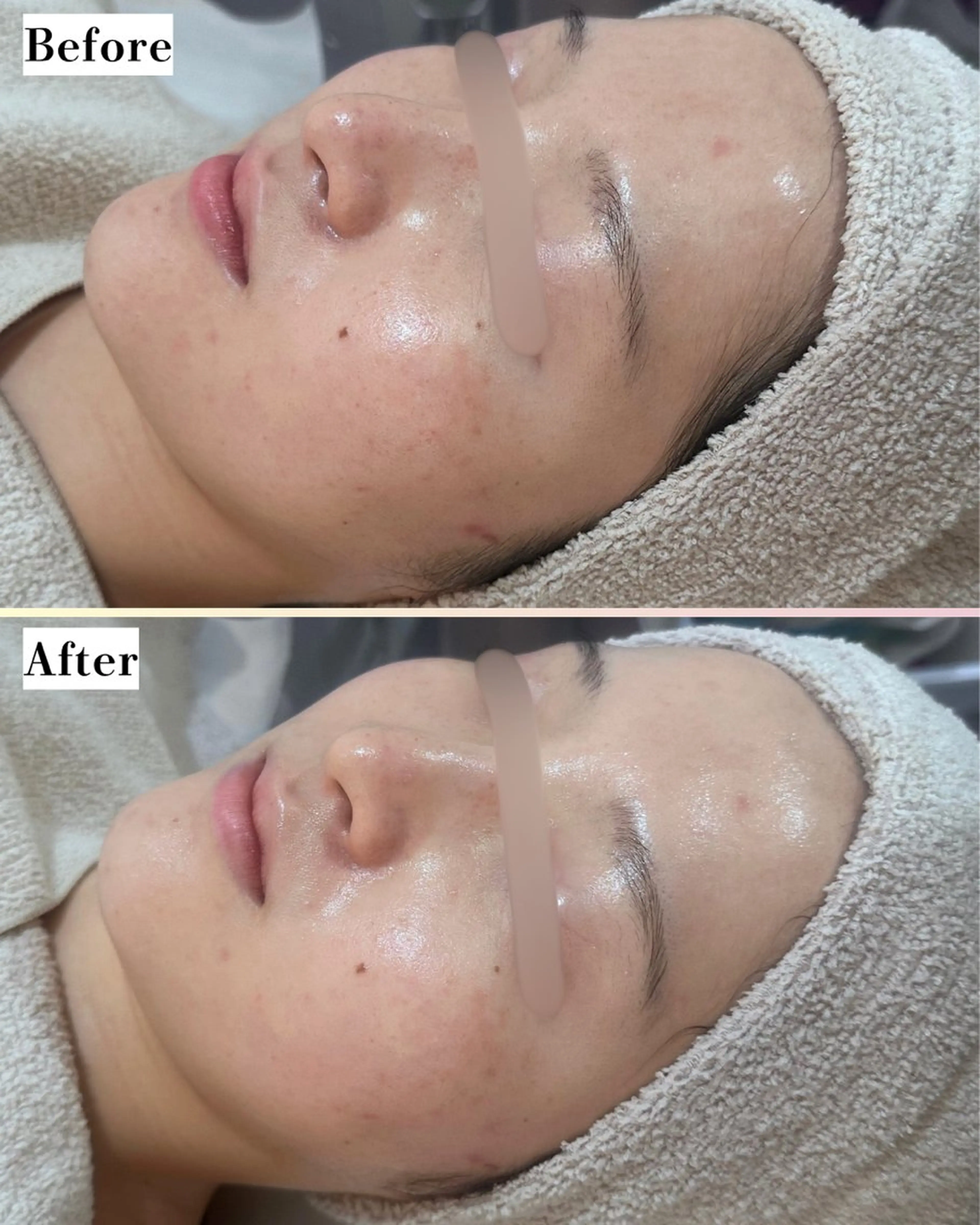 エステ |ピーリング・毛穴| soina神楽坂のエステ・リラクイメージ