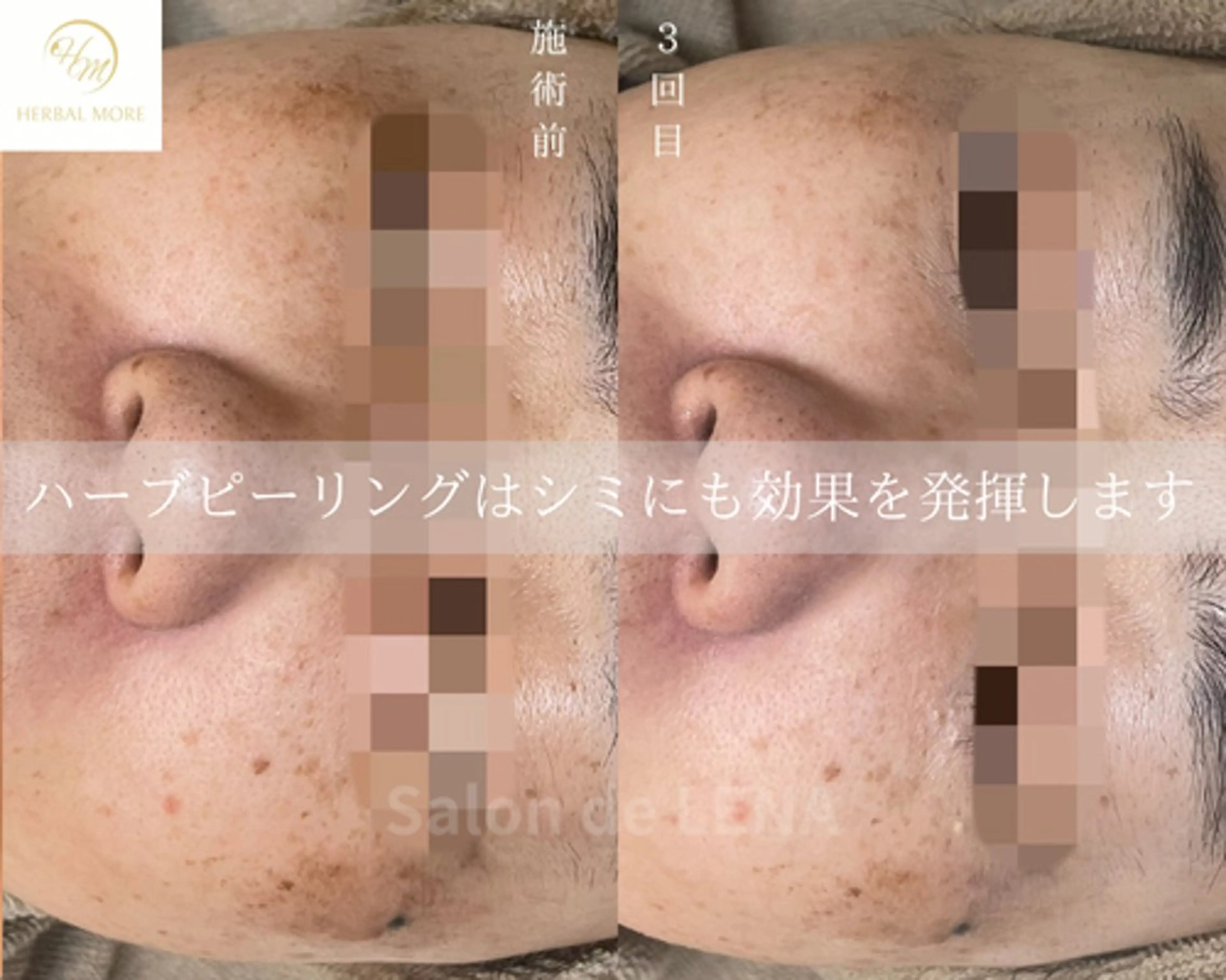エステ ハーブピーリング専門 サロンドレナ平岡のエステ・リラクイメージ
