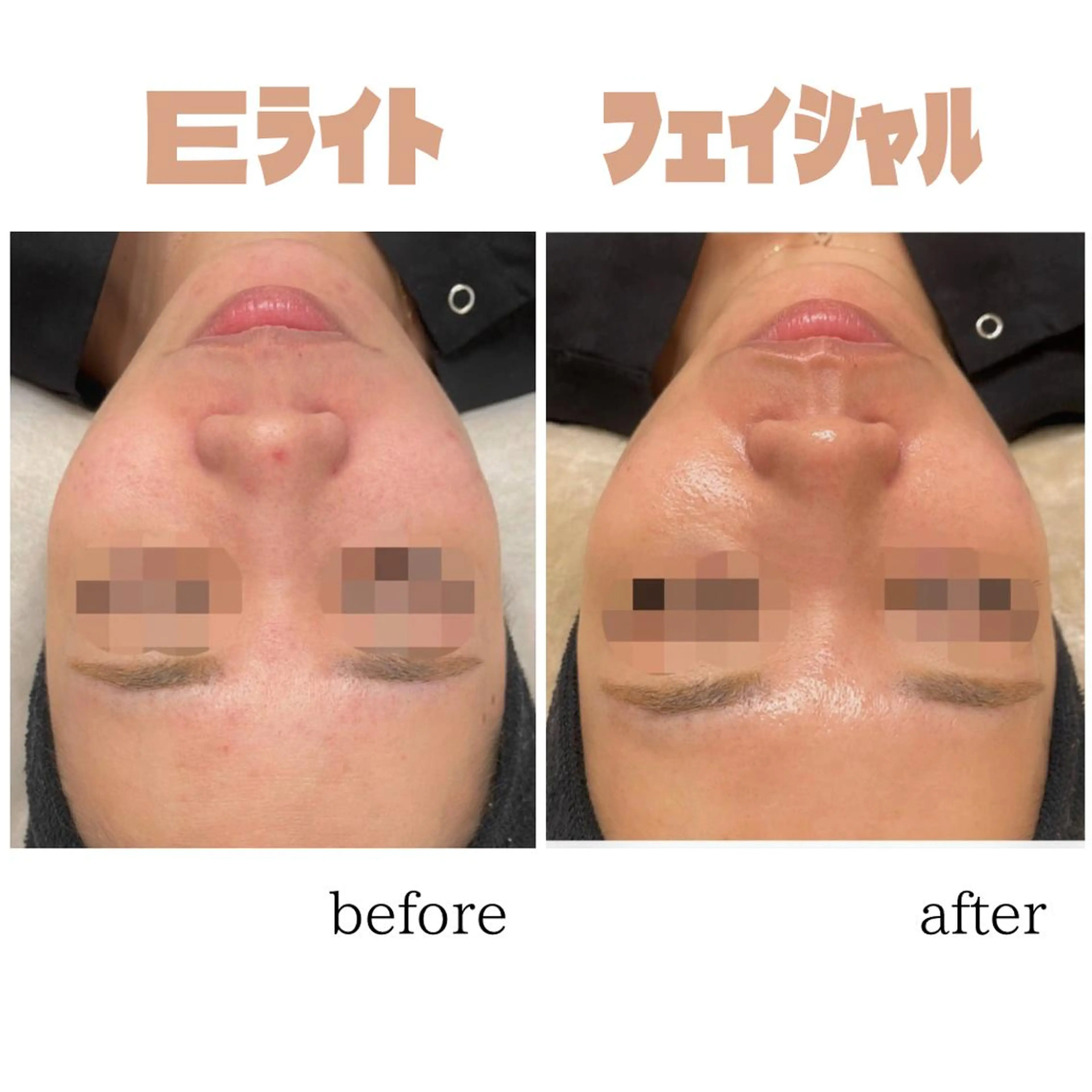 しみやしわ、毛穴開きが気になる方！肌質を改善しながらリフトアップ！🌟 【Eライト光フェイシャル2周】の写真