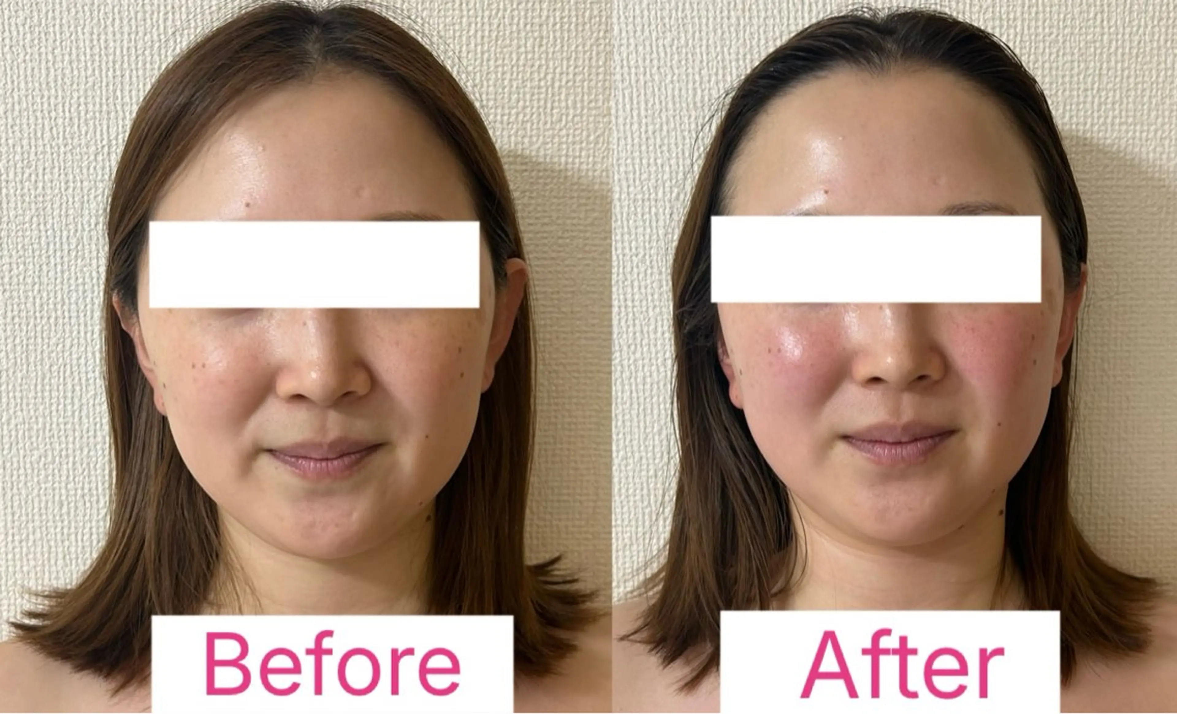 初回体験価格！モニタープラン①                              トライアングルフェイシャル®️の写真