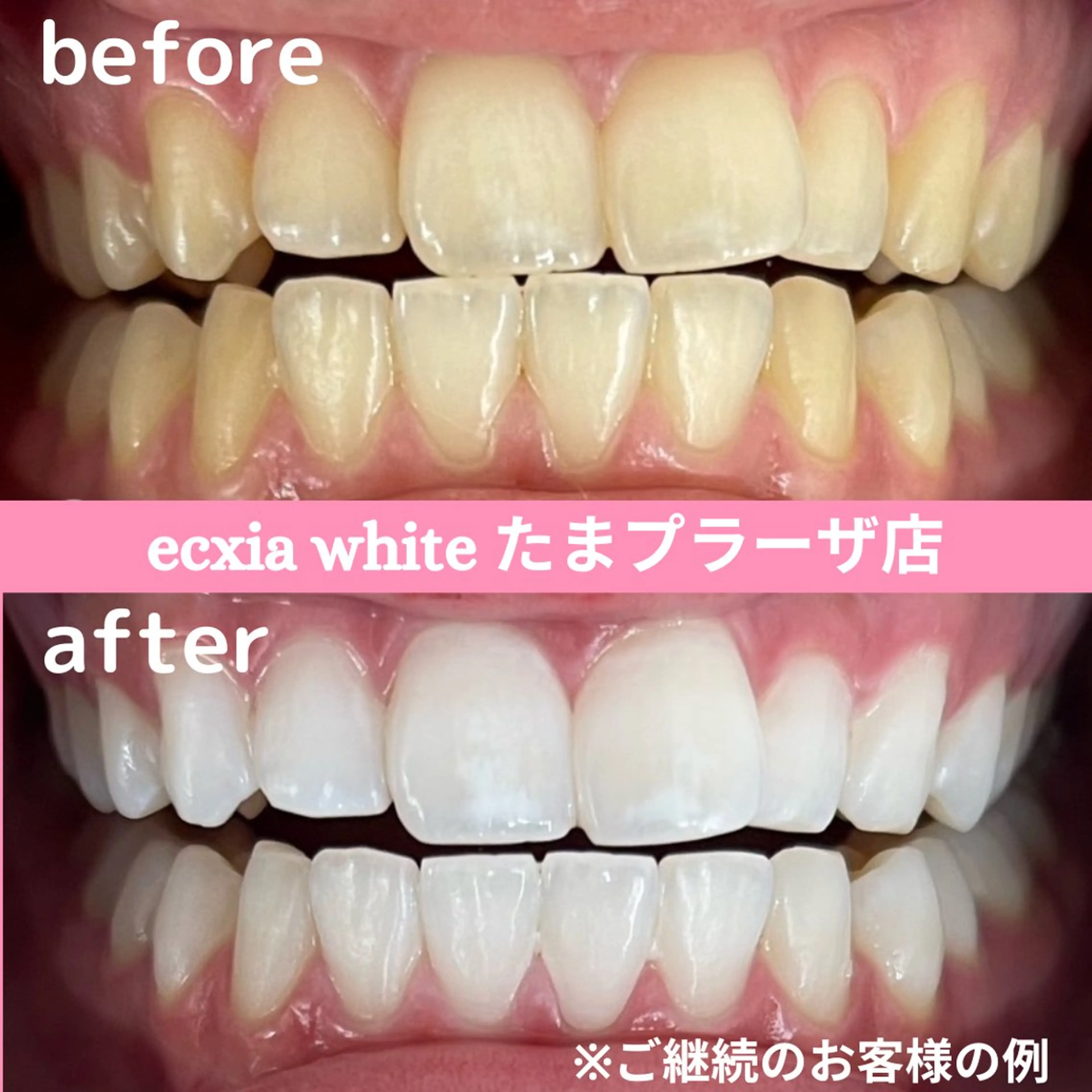 人気No.1!!平均5トーンUP⭐︎たっぷり60分プレミアム歯科ホワイトニング初回体験 ¥14800→¥11000の写真