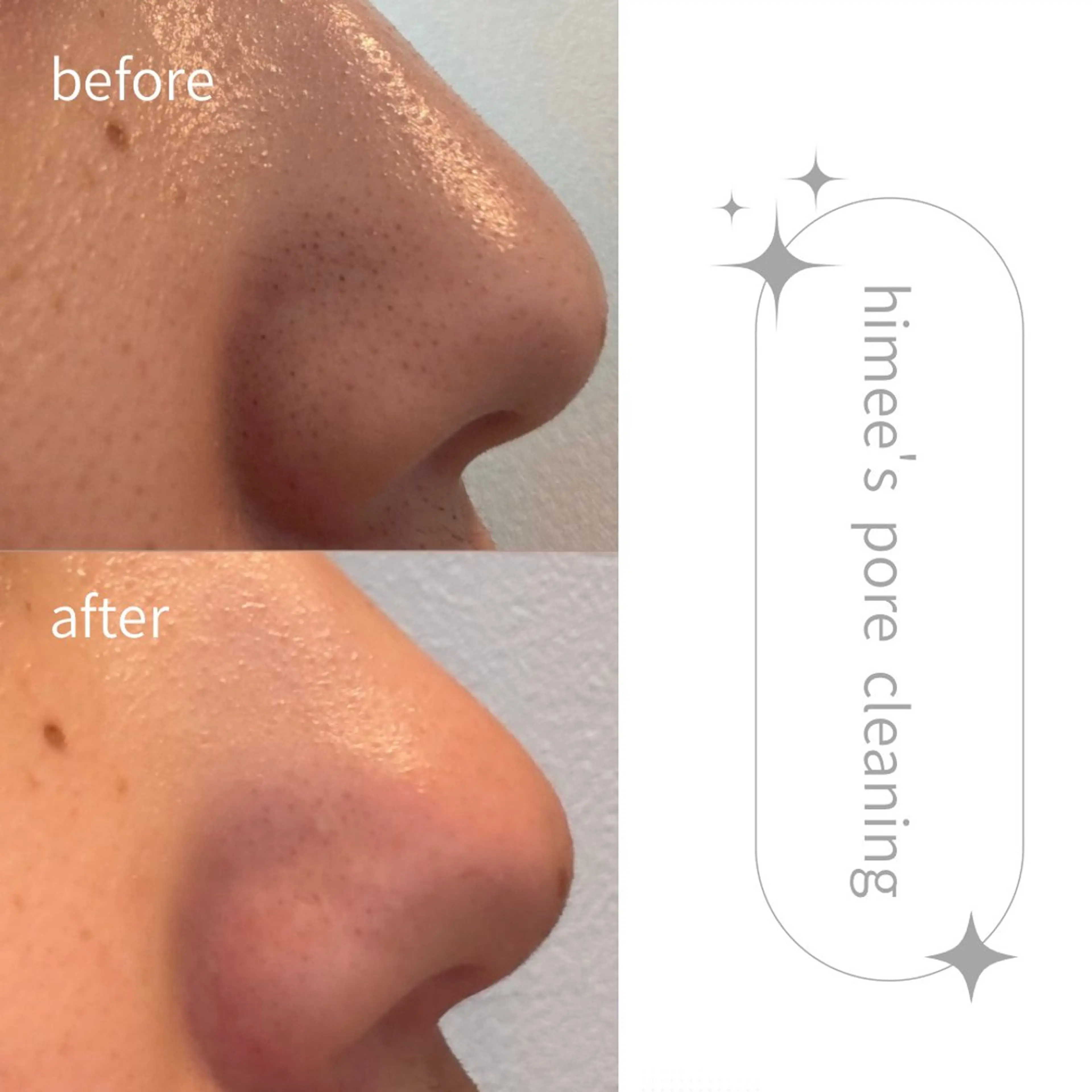 エステ リラク 艶肌ハーブピーリング /毛穴洗浄のエステ・リラクイメージ