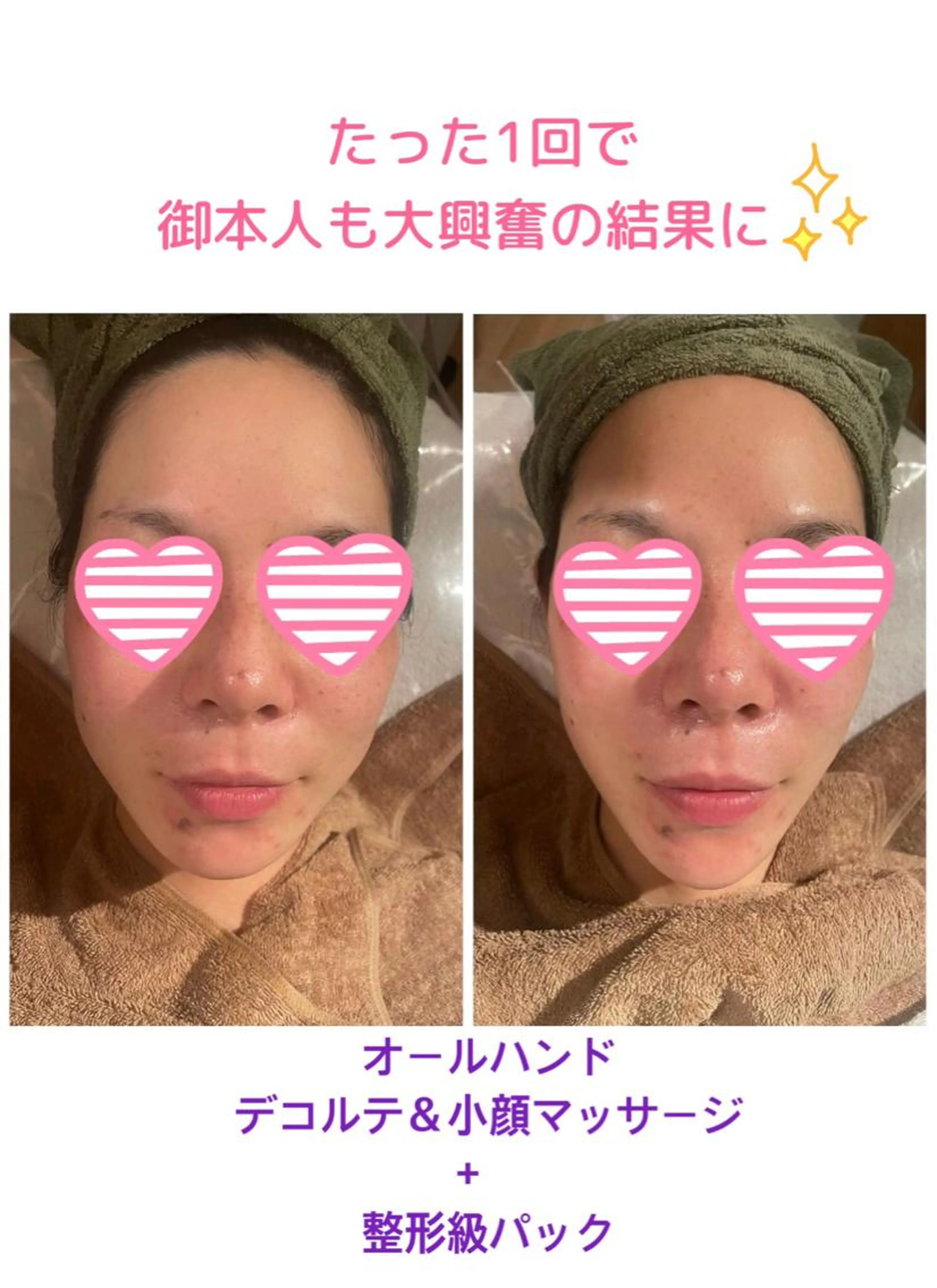 【フェイシャル】整形級✨1回で感動の結果🥹✨小顔マッサージ✖️MTメタトロン✖️母細胞を鍛える炭酸ガスパック　75分の写真