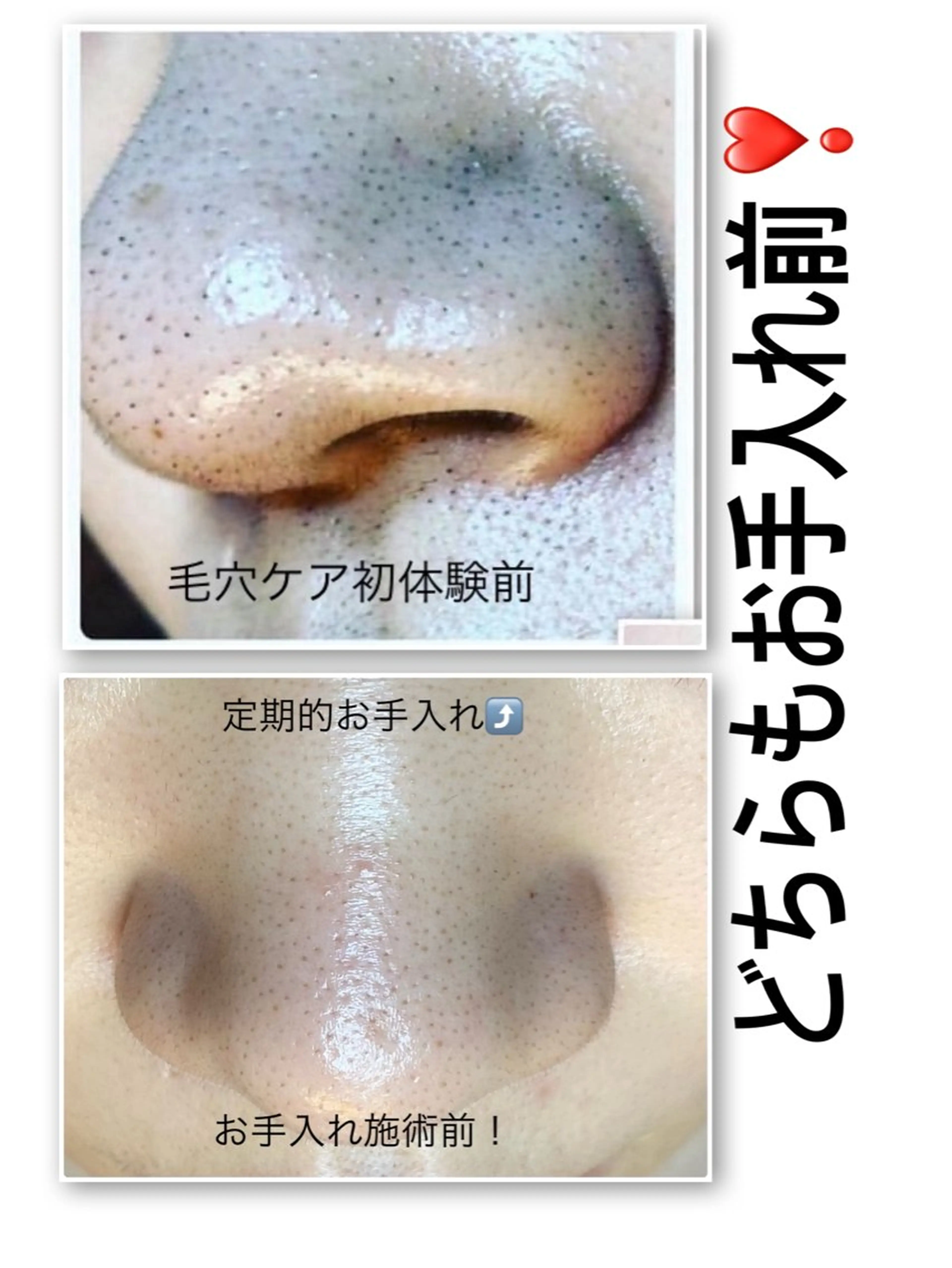 tete式毛穴エクストラクションの写真