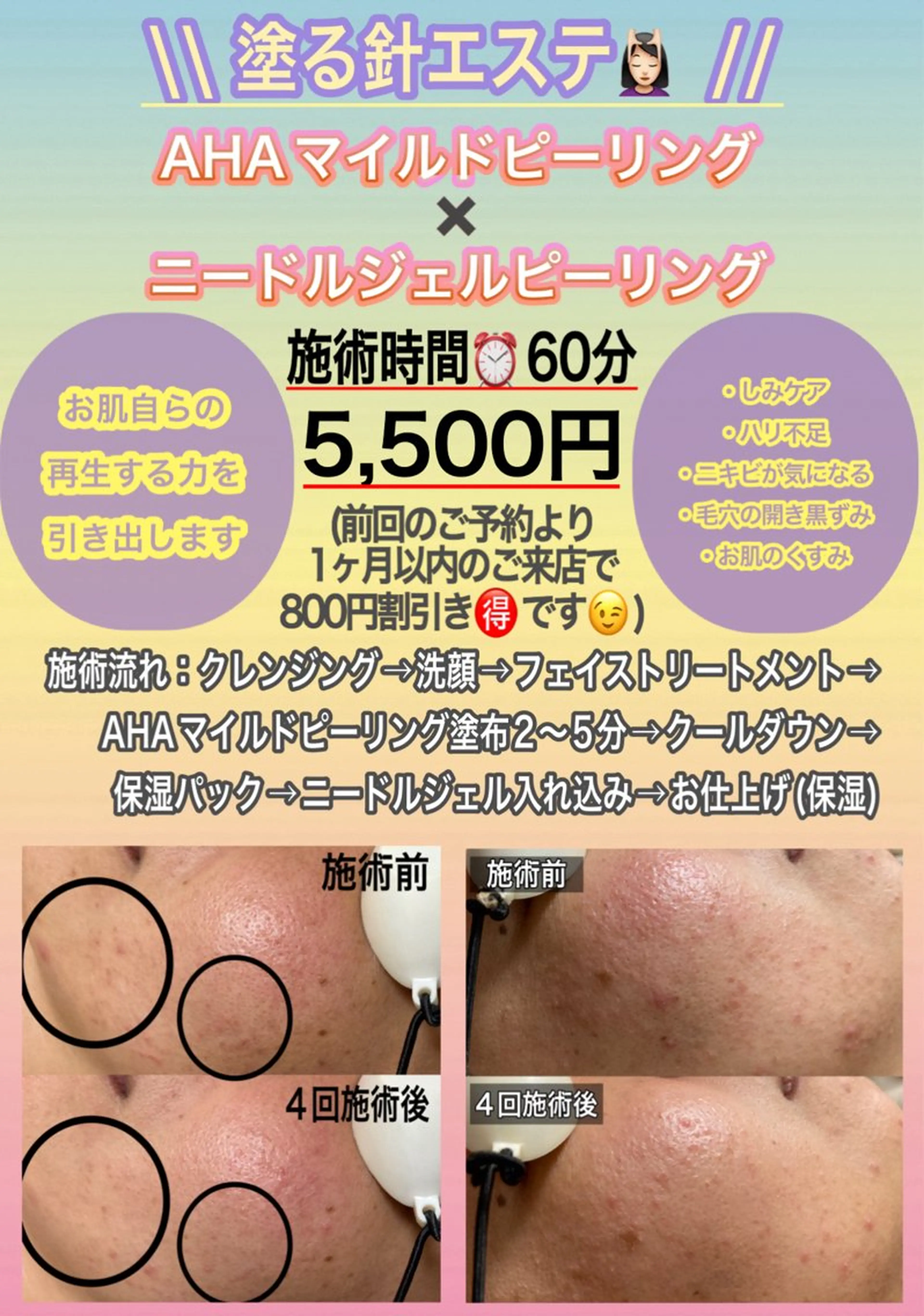 新メニュー🆕【塗る針エステ60分】今話題のスピキュールやCICA配合ジェル使用🫧の写真