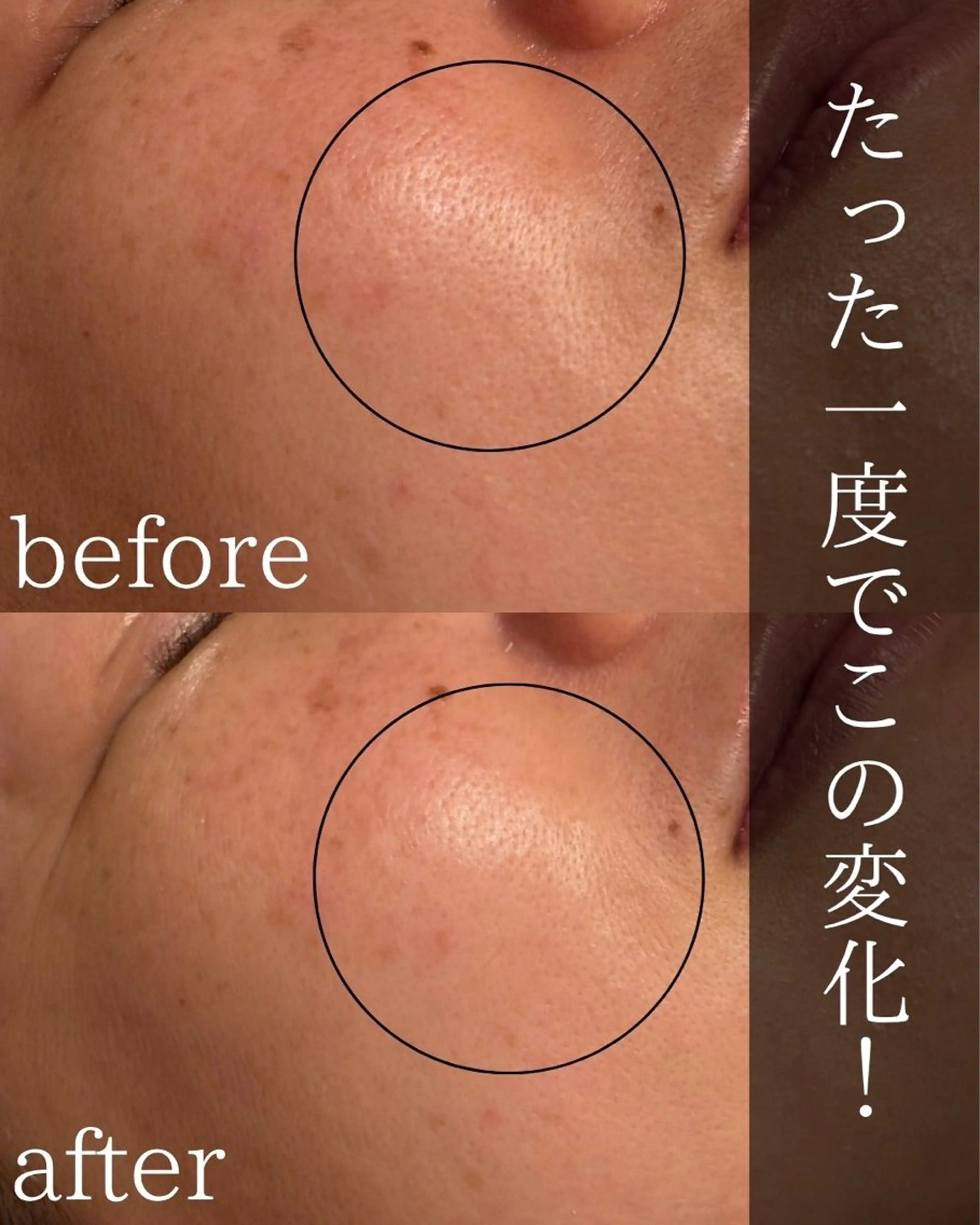 フェイシャルワックス×韓国で話題の炭酸ガスパック　カーボキシー　一度で効果実感！肌質改善！の写真