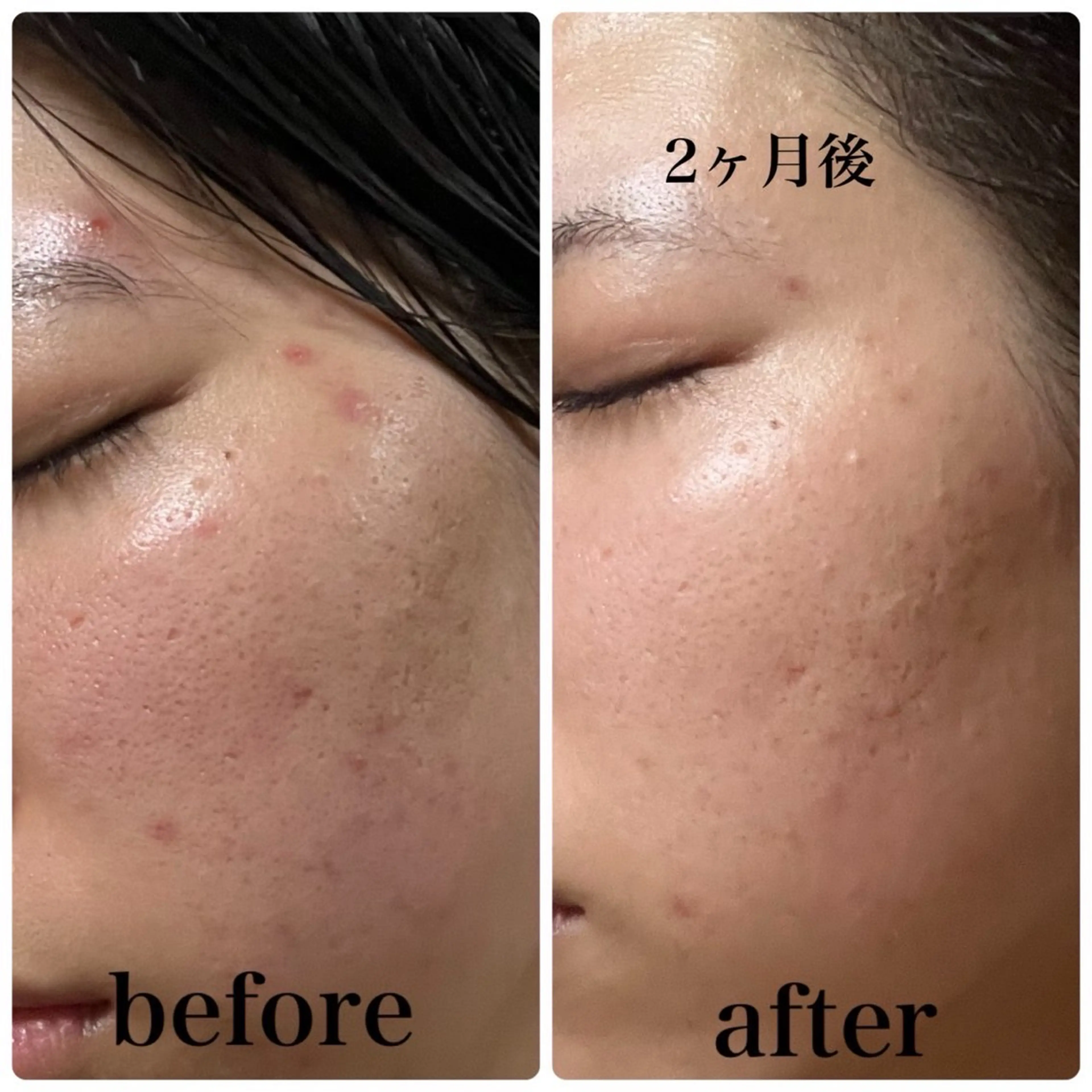 【Xで大バズり中🔥ポーラ肌分析】精密肌カメラを使ったお肌検査👀✨ 肌悩みや自分に合うケアを知りたい方の入口🚪の写真