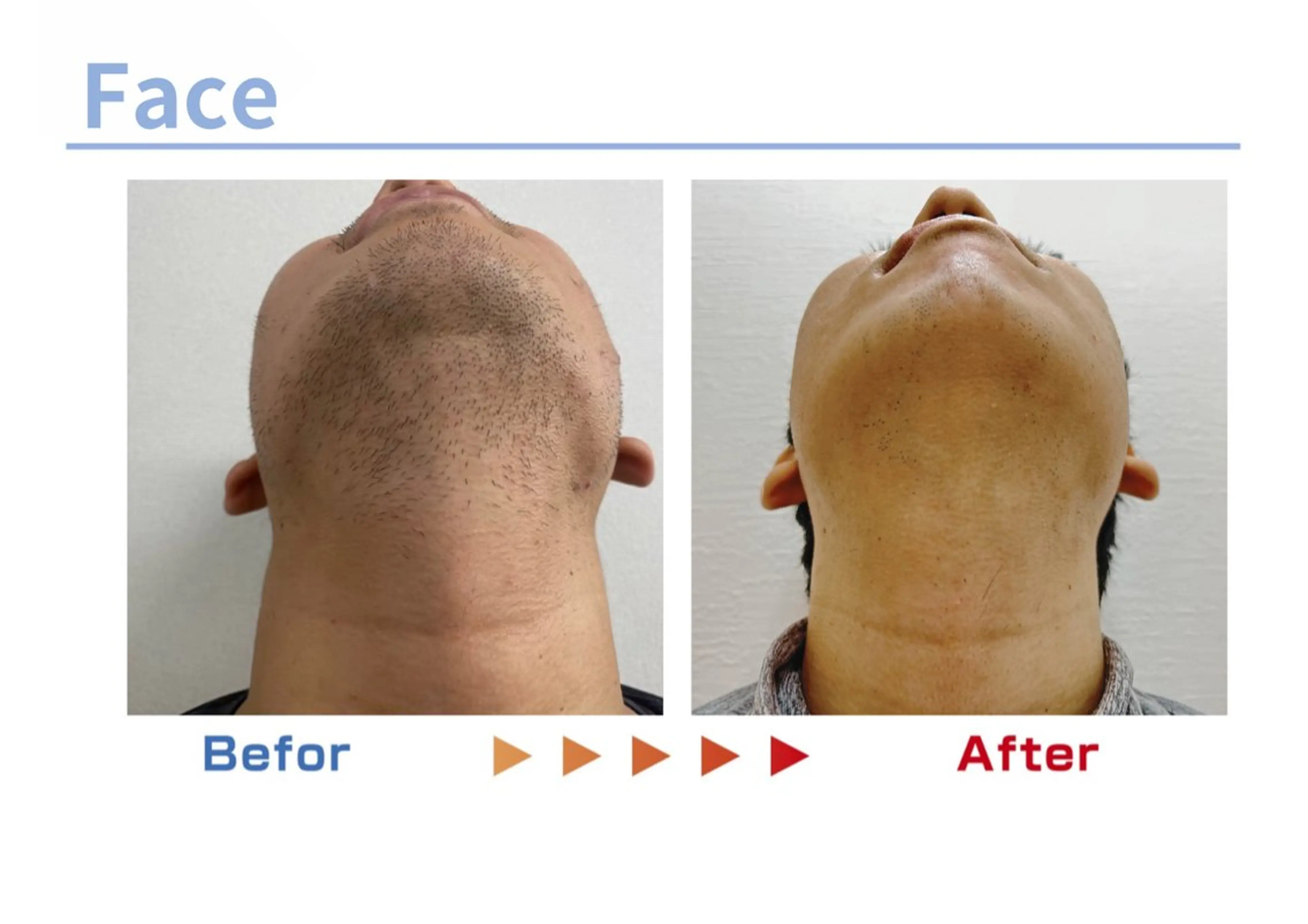 脱毛 セルフ脱毛/美尻イス キングスサロン熊本のエステ・リラクイメージ