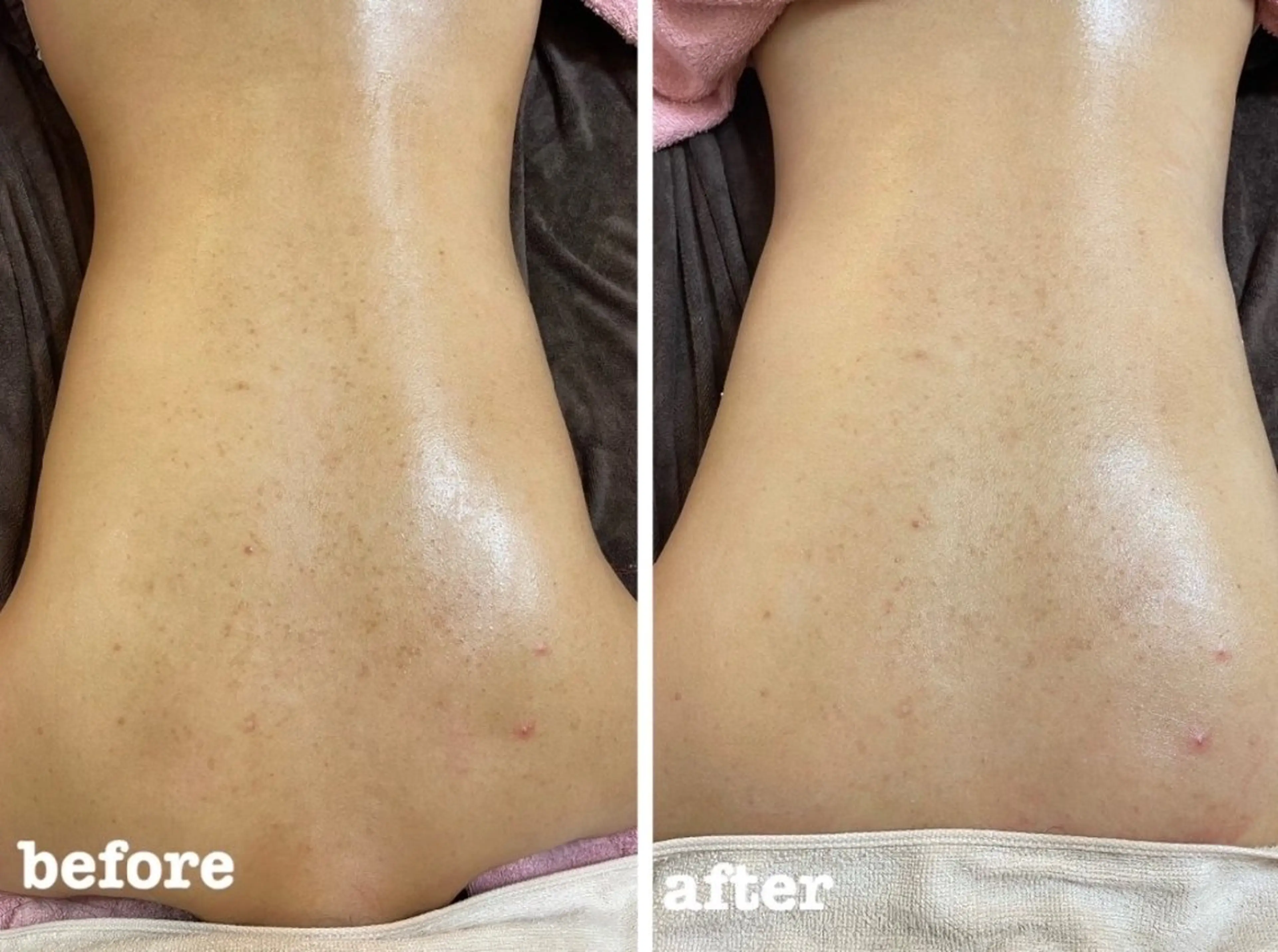 【背中ニキビ・シミなどが気になる方】背中上部をお試しでVCFリキッドプレゼントの写真