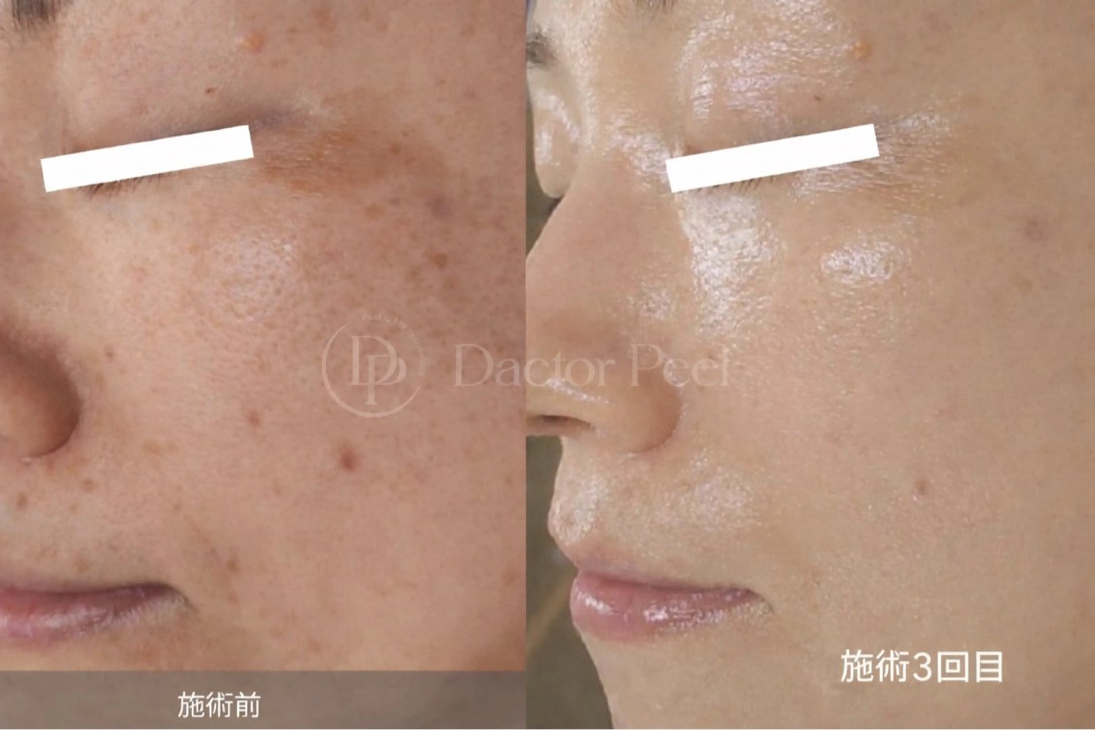 【結果重視◆シミたるみ改善】ダクトピール×高濃度美容液導入×ヘッドスパの写真