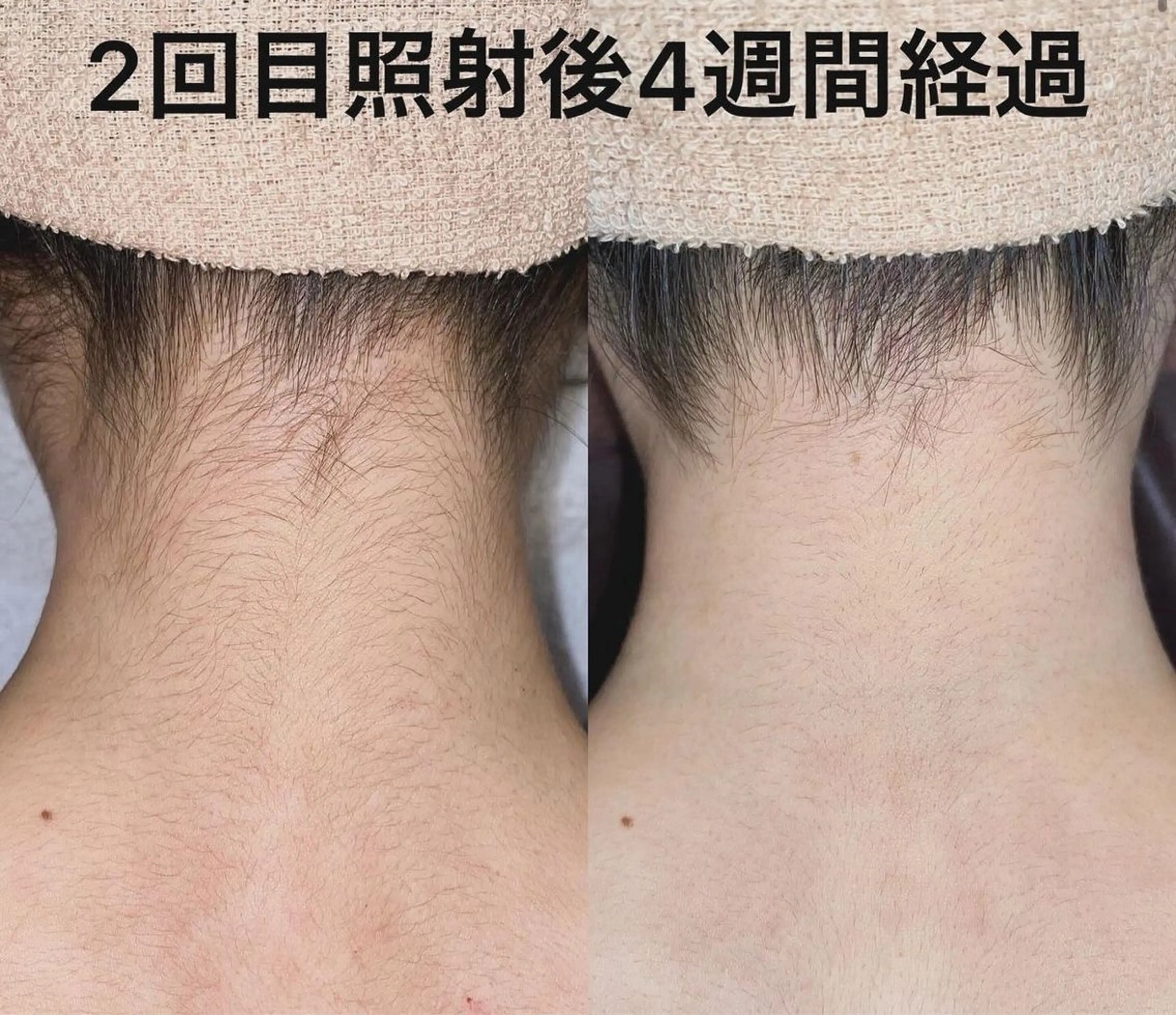 脱毛 【ena】 YUKOのマツエク・マツパデザイン