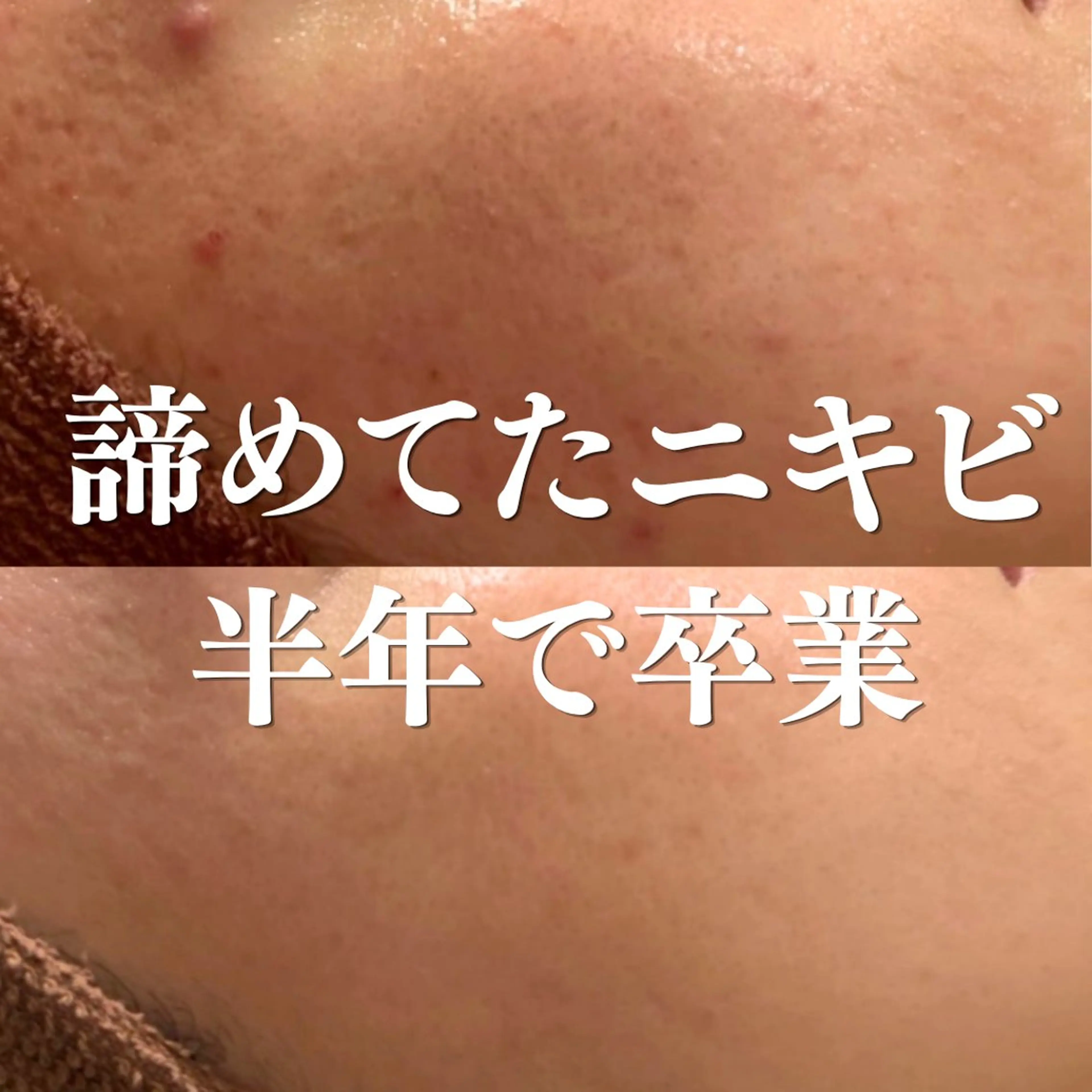 エステ リラク ニキビ特化型エステ 🍋最短で肌質改善のエステ・リラクイメージ