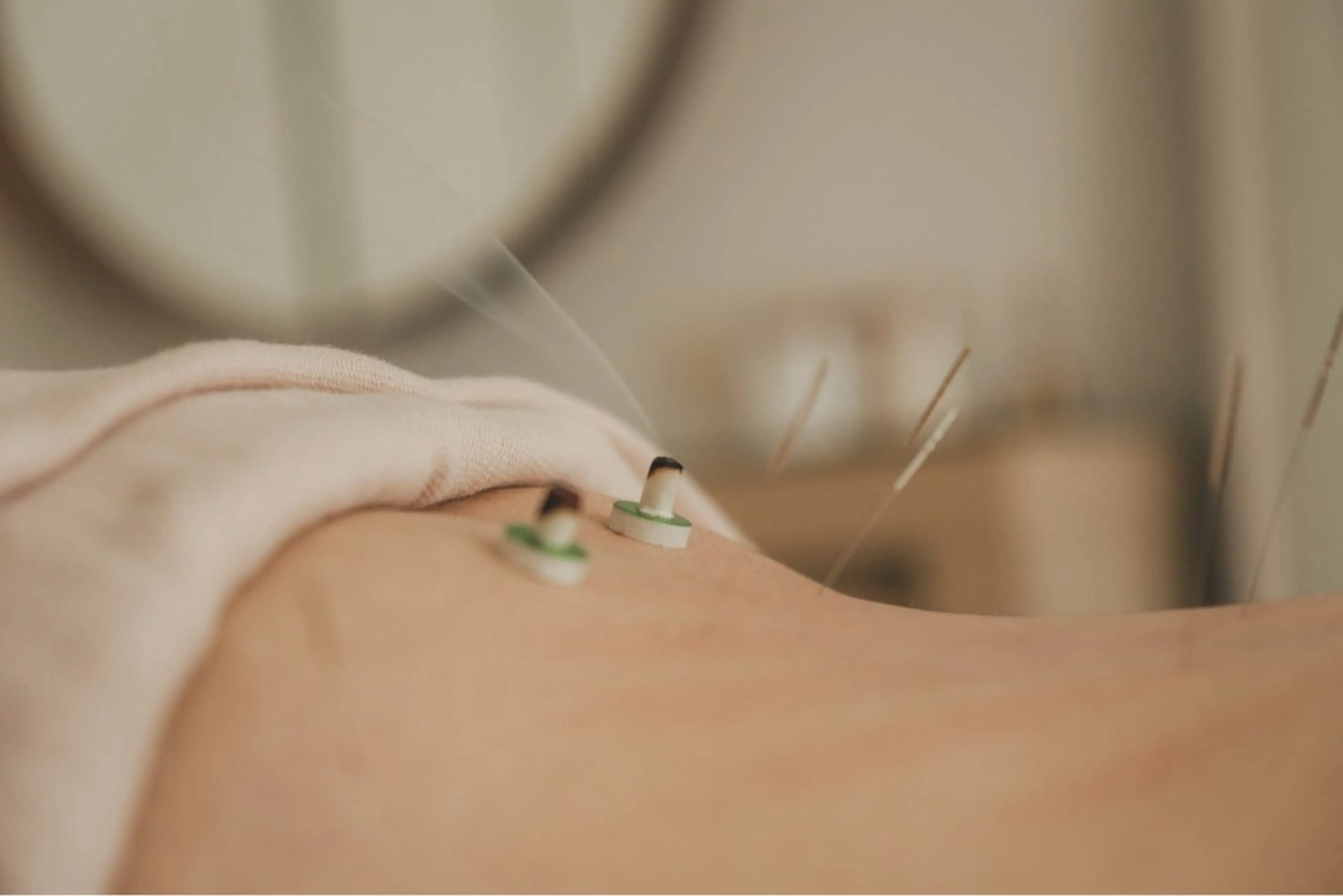 身体鍼灸の写真