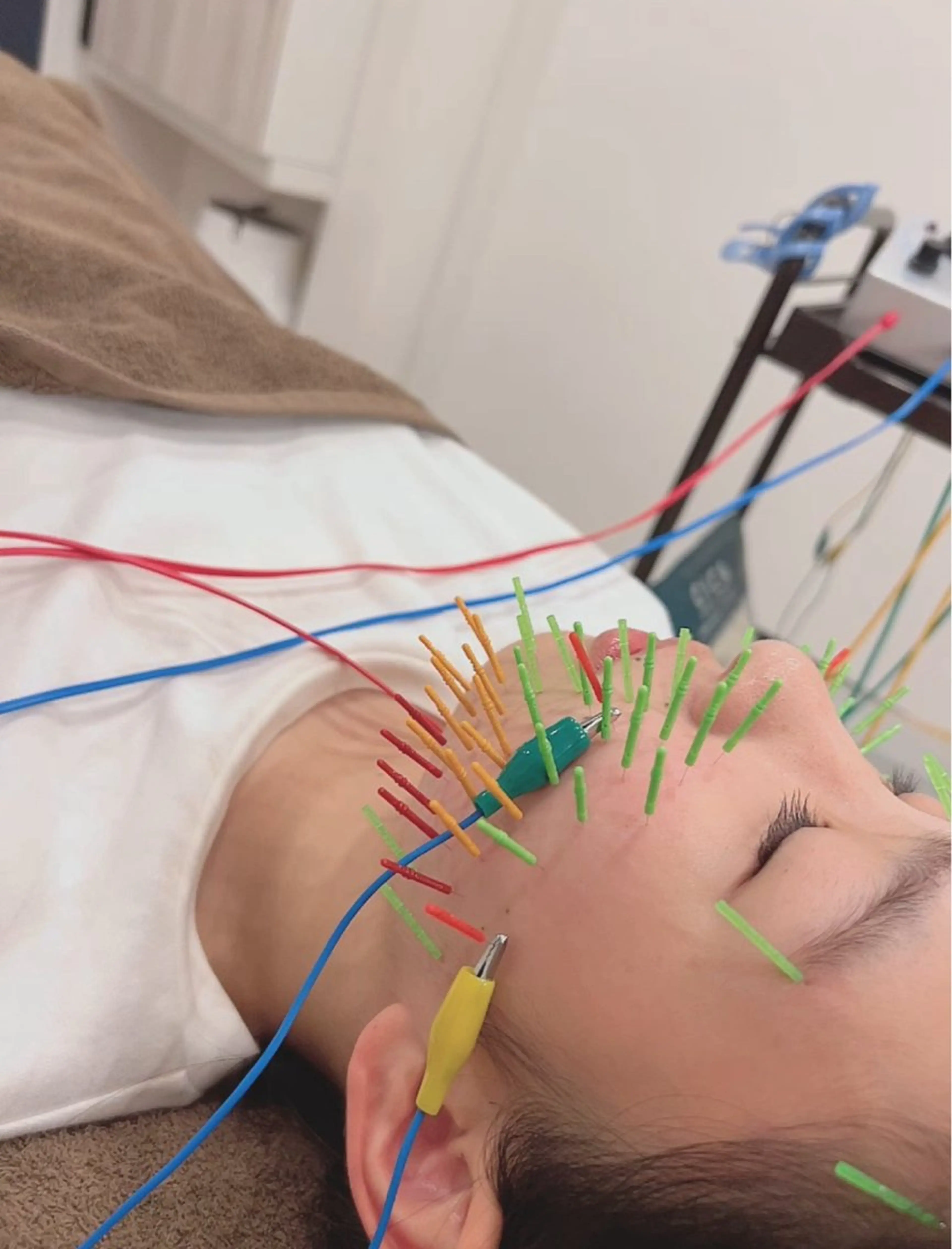 エステ リラク 美容鍼灸Solana所属・肌質改善×美容鍼 ゆいのエステ・リラクイメージ