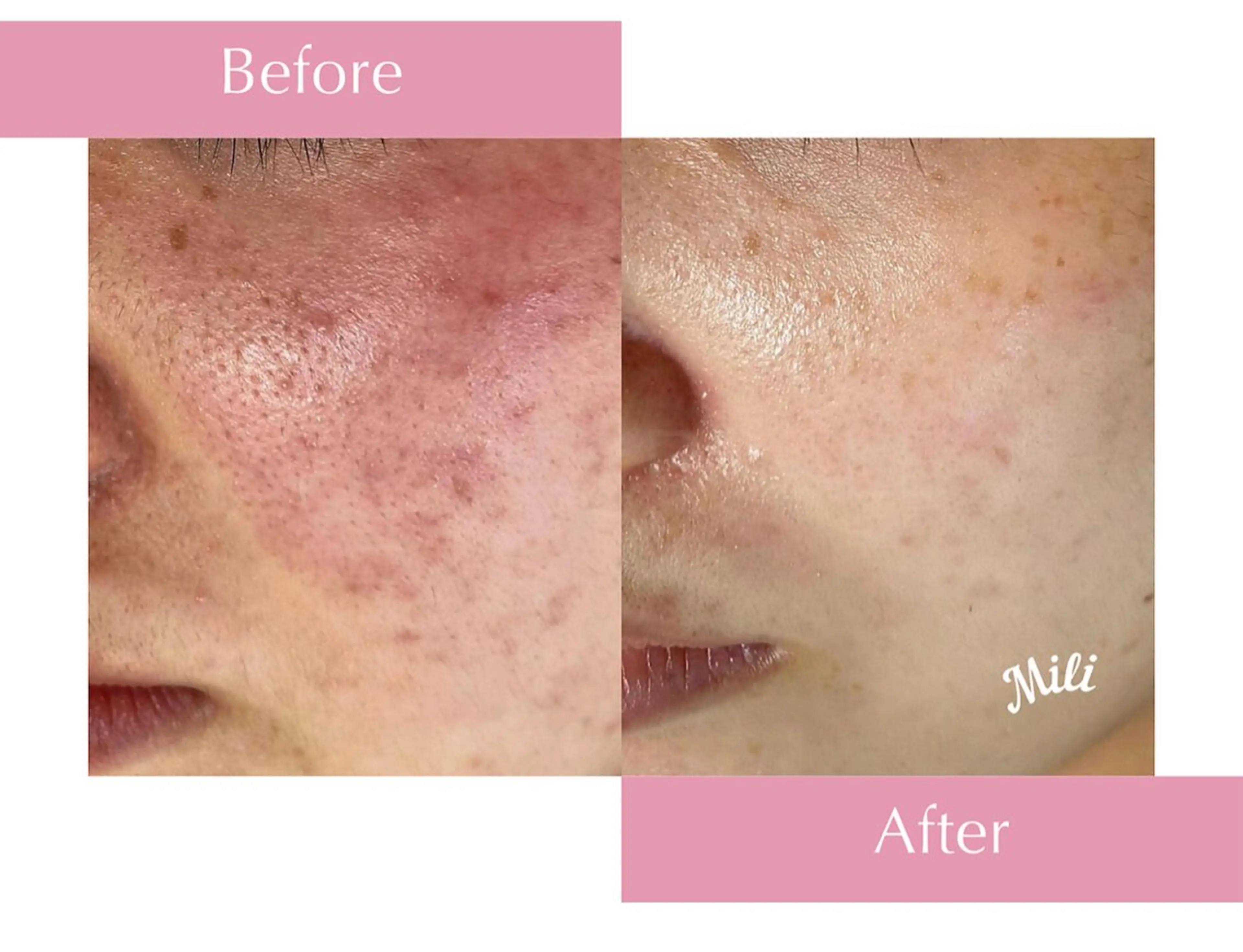 \１周年記念/ ✨【人気No.1💎90分コース】毛穴、肌荒れ、ニキビ集中ケア★美容導入も付けさせていただきます✨️の写真