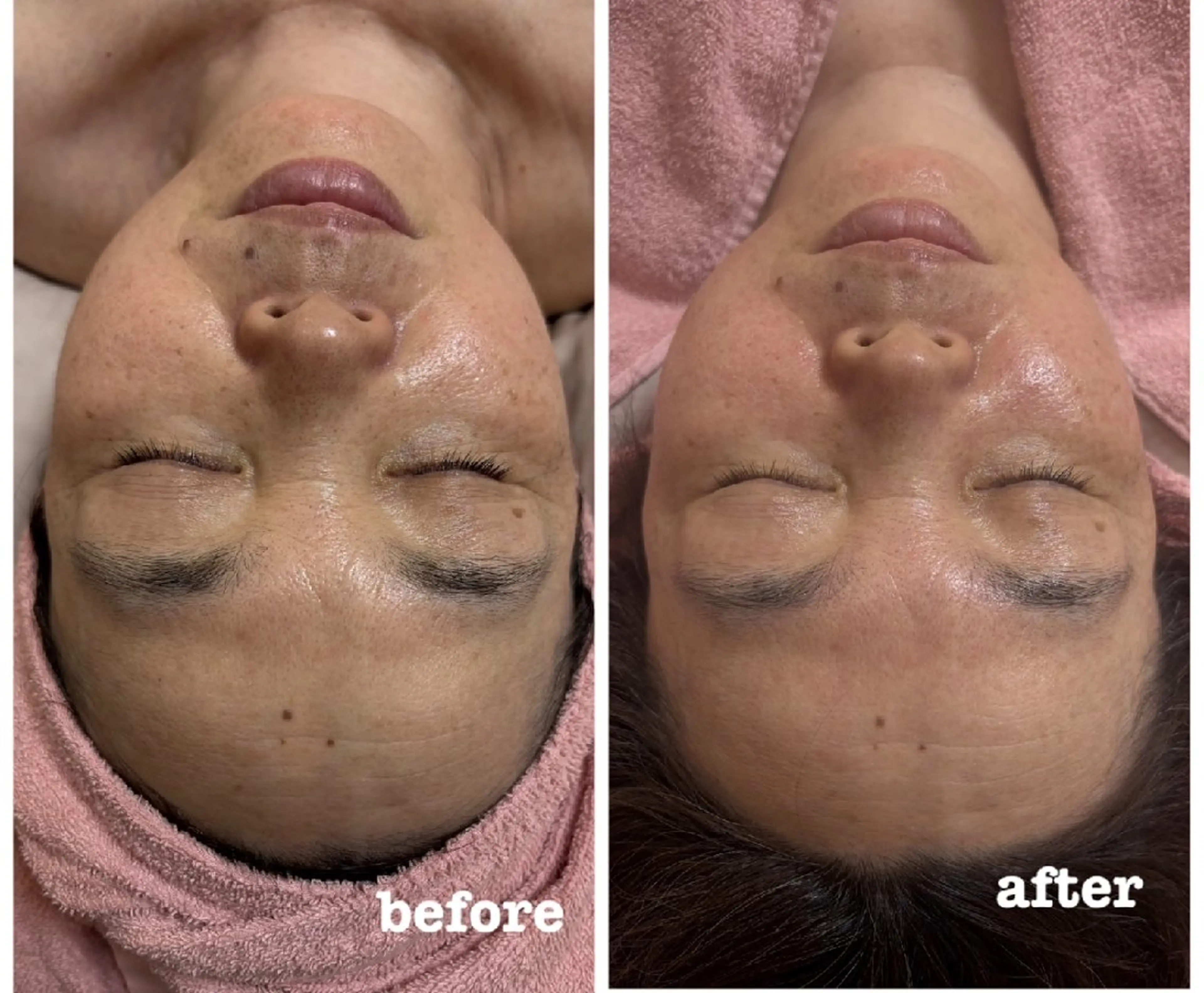 ハードタイプ（剥離あり）のハーブピーリング　アフターケアのスキンケア商品プレゼントの写真