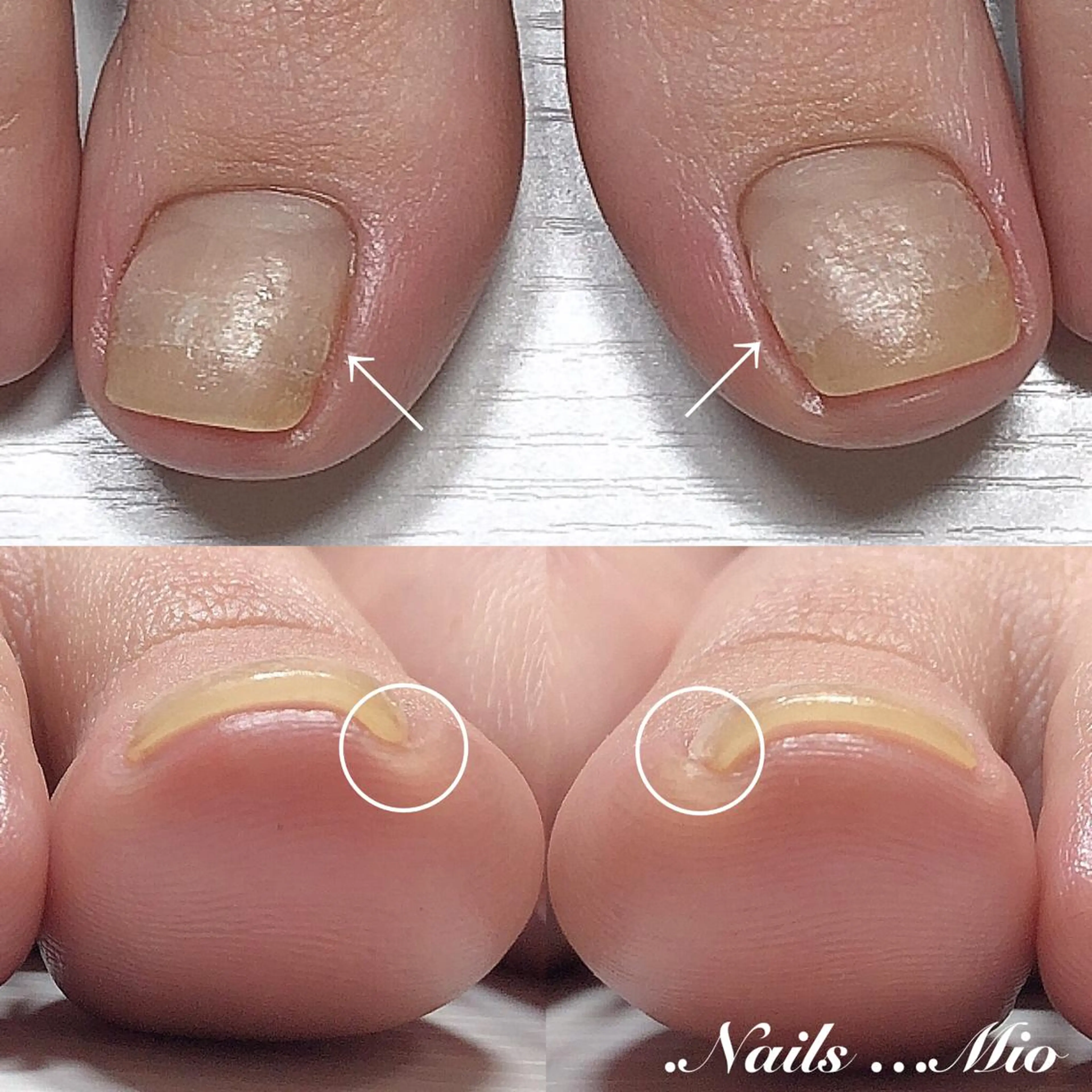 👣巻爪矯正ケアドイツ式B/Sブレイス親指1本30の写真