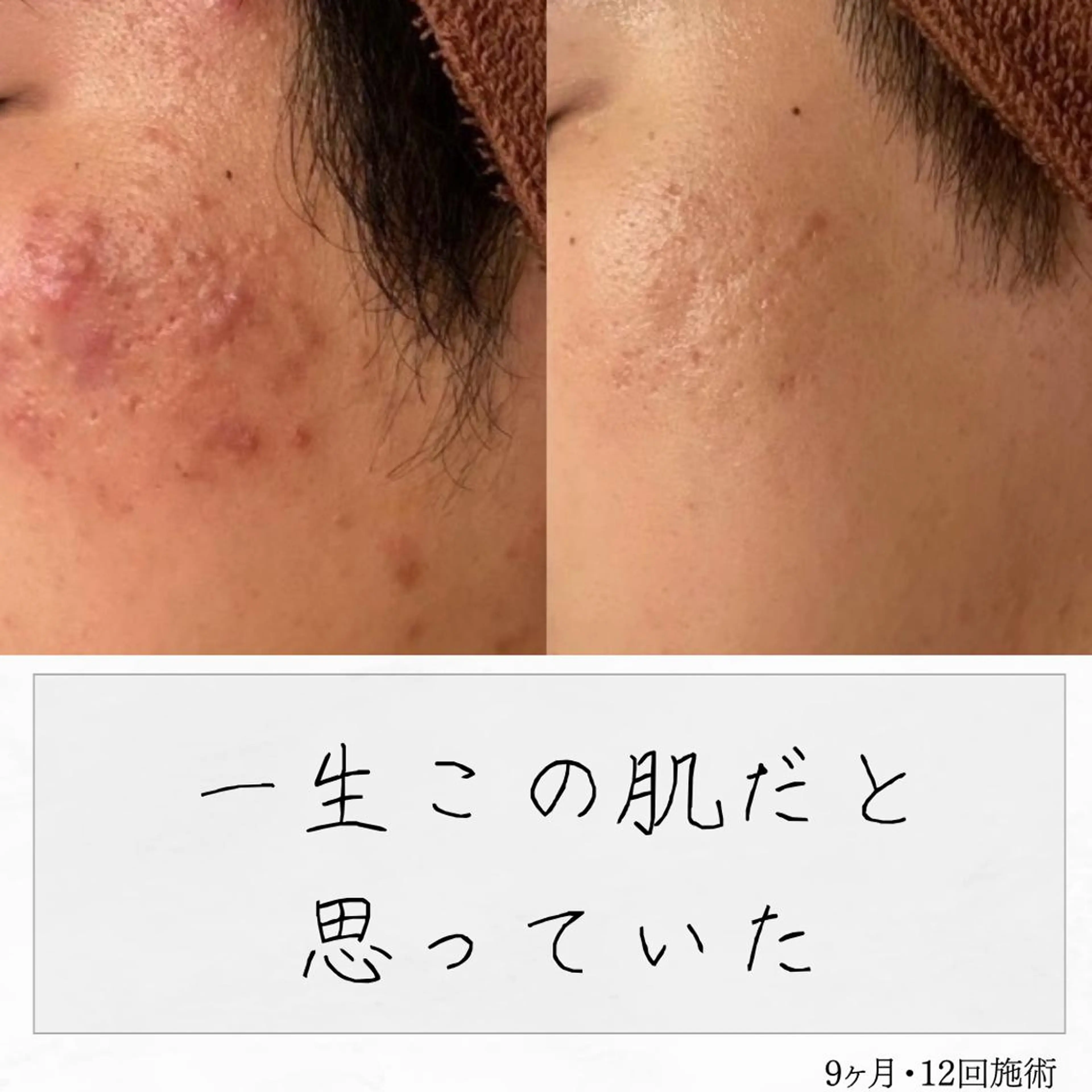 ニキビ経験者が施術 する専門サロン🌻のエステ・リラクイメージ