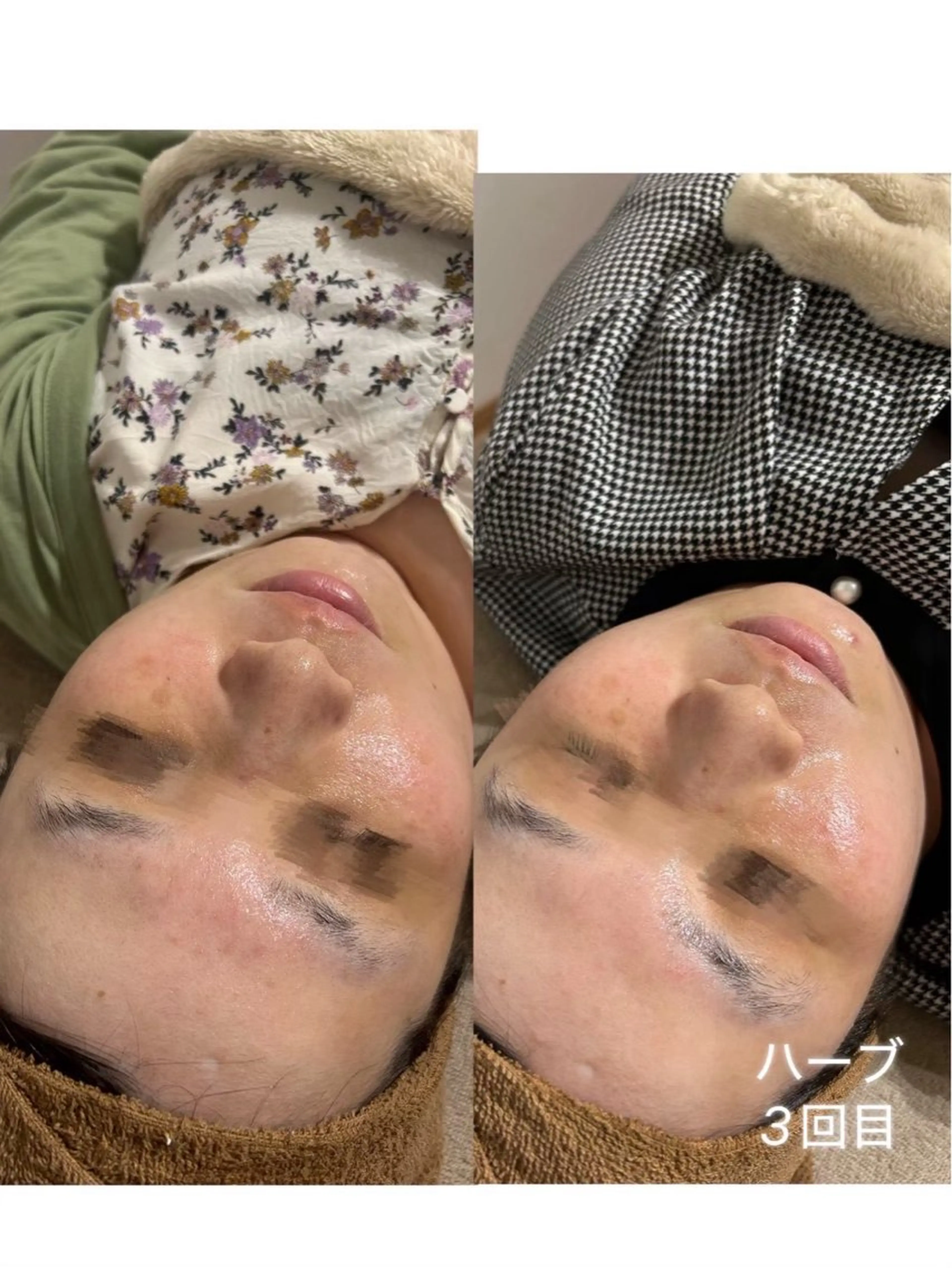 【肌質底上げ🌿】ハーブピーリングの写真