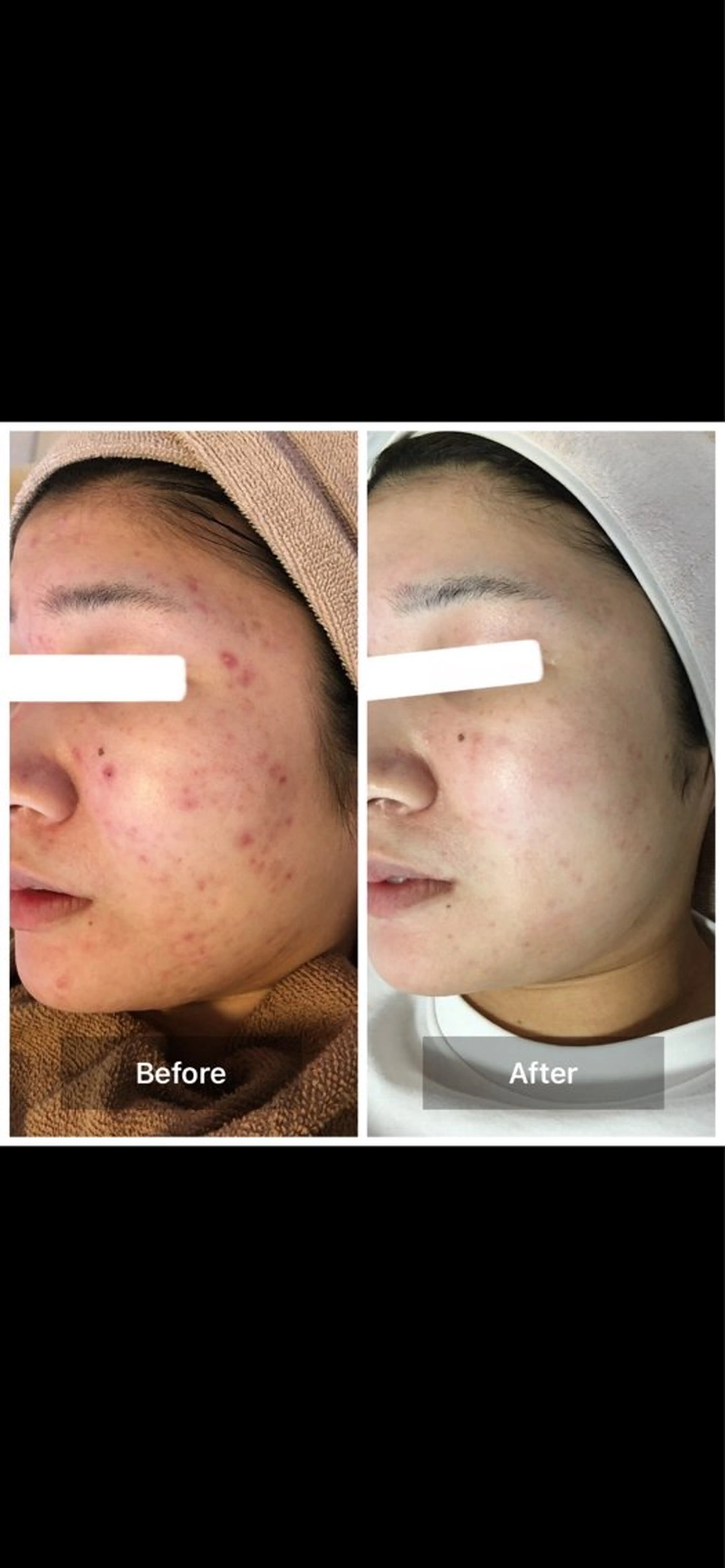 人気No.1👑✨💕ハイドラ＋ハーブピーリング剥離あり🌿毛穴黒ずみ　美白　シミ　ニキビ　ニキビ跡　クレーター　くすみの写真